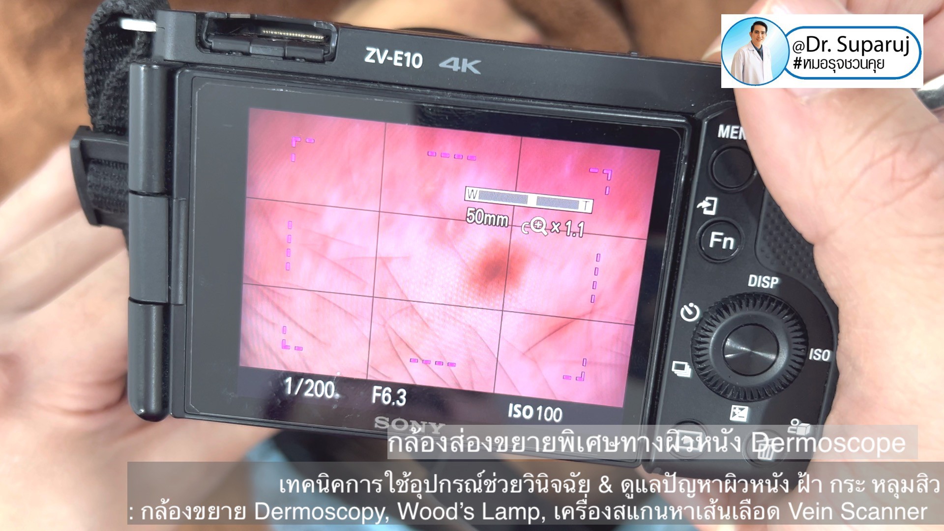 เทคนิคการใช้อุปกรณ์ช่วยวินิจฉัย & ดูแลปัญหาผิวหนัง ฝ้า กระ หลุมสิว: กล้องขยาย Dermoscopy, แว่นขยายพร้อมแสงในช่วงUV: Wood’s Lamp, เครื่องสแกนหาเส้นเลือด Vein Scanner เทคนิคการใช้อุปกรณ์ช่วยวินิจฉัย & ดูแลปัญหาผิวหนัง ฝ้า กระ หลุมสิว: กล้องขยาย Dermoscopy, แว่นขยายพร้อมแสงในช่วงUV: Wood’s Lamp, เครื่องสแกนหาเส้นเลือด Vein Scanner