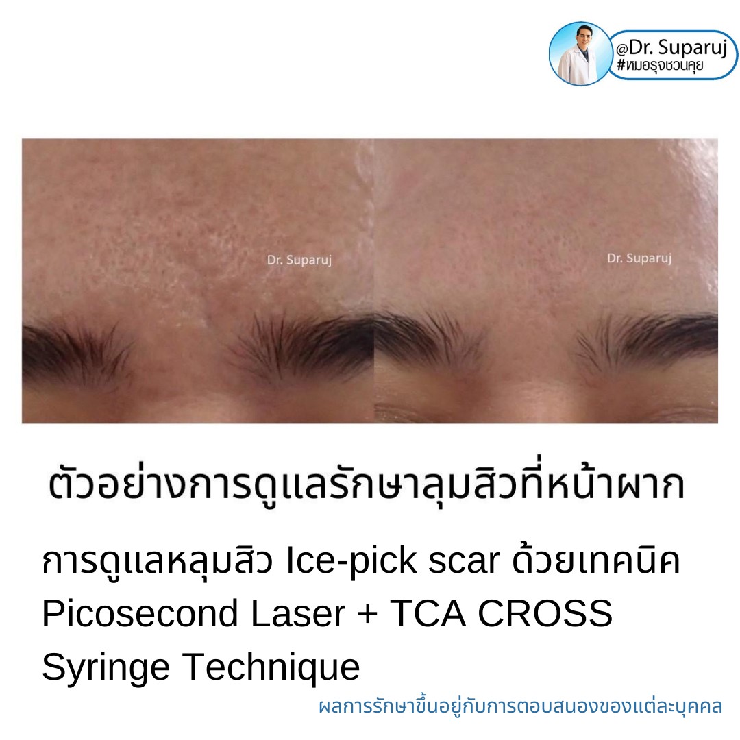 แนะนำเทคนิครักษาหลุมสิวจิกลึก Ice Pick Acne Scar ด้วยเทคนิคเลเซอร์ UltraDeep Pico Technique (Ice Pick Acne Scar Treatment with Discovery Pico Laser + UltraDeep Pico Technique) แนะนำเทคนิครักษาหลุมสิวจิกลึก Ice Pick Acne Scar ด้วยเทคนิคเลเซอร์ UltraDeep Pico Technique (Ice Pick Acne Scar Treatment with Discovery Pico Laser + UltraDeep Pico Technique)