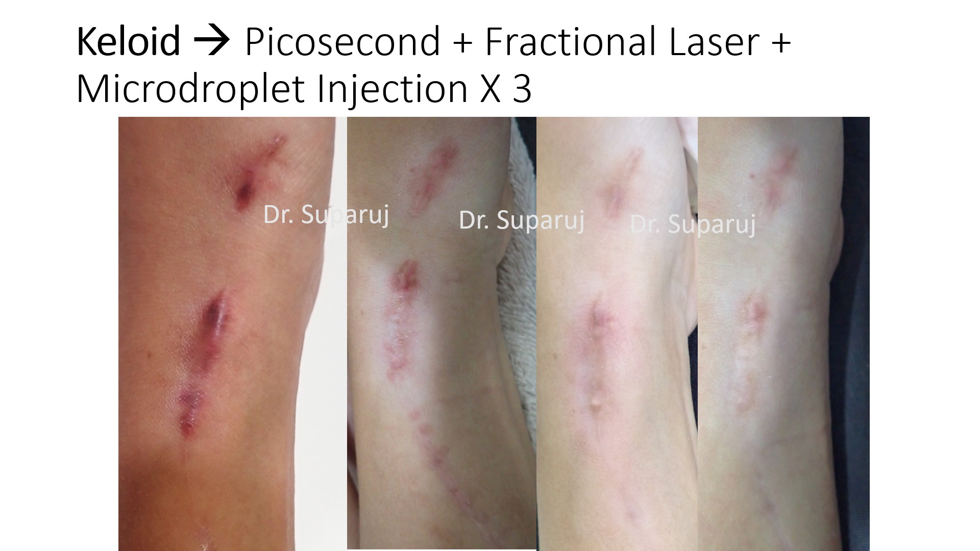 เทคนิคดูแลแผลเป็นนูน คีลอยด์ Keloid ด้วยเลเซอร์ Triple Laser Therapy: Picosecond + Gold Toning + Fractional Laser  