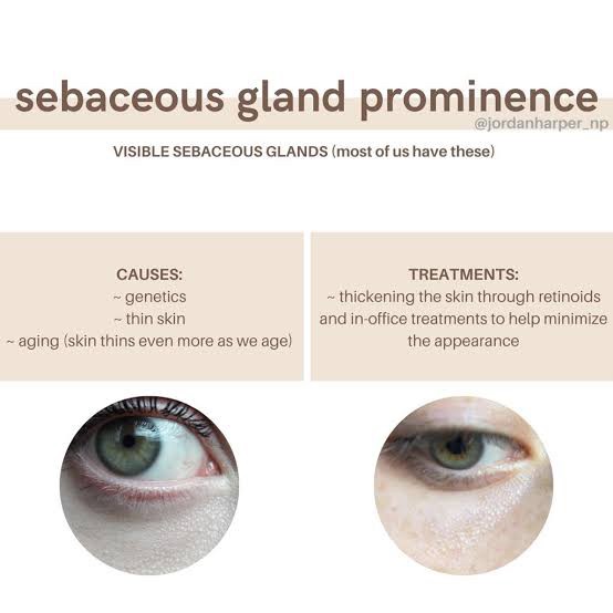 มีตุ่มเล็กๆสีขาวเหลืองหลายๆตุ่มที่เปลือกตาล่างคืออะไร : เป็นต่อมไขมันที่เด่นชัดครับ Prominent sebaceous gland ครับ มีตุ่มเล็กๆสีขาวเหลืองหลายๆตุ่มที่เปลือกตาล่างคืออะไร : เป็นต่อมไขมันที่เด่นชัดครับ Prominent sebaceous gland ครับ