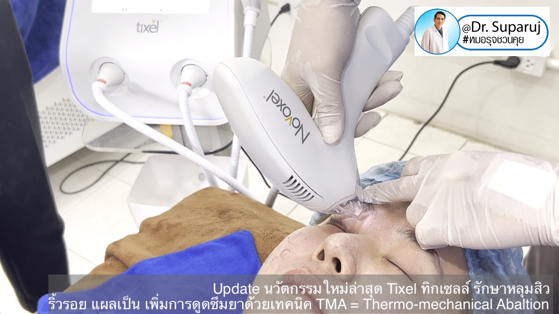 Update นวัตกรรมใหม่ล่าสุด Tixel ทิ๊กเซลล์ รักษาหลุมสิว ริ้วรอย แผลเป็น + Periorbital Tixel Treatment ดูแลริ้วรอยเปลือกตาและรอบดวงตาด้วยเทคนิค TMA = Thermo-mechanical Abaltion Update นวัตกรรมใหม่ล่าสุด Tixel ทิ๊กเซลล์ รักษาหลุมสิว ริ้วรอย แผลเป็น + Periorbital Tixel Treatment ดูแลริ้วรอยเปลือกตาและรอบดวงตาด้วยเทคนิค TMA = Thermo-mechanical Abaltion