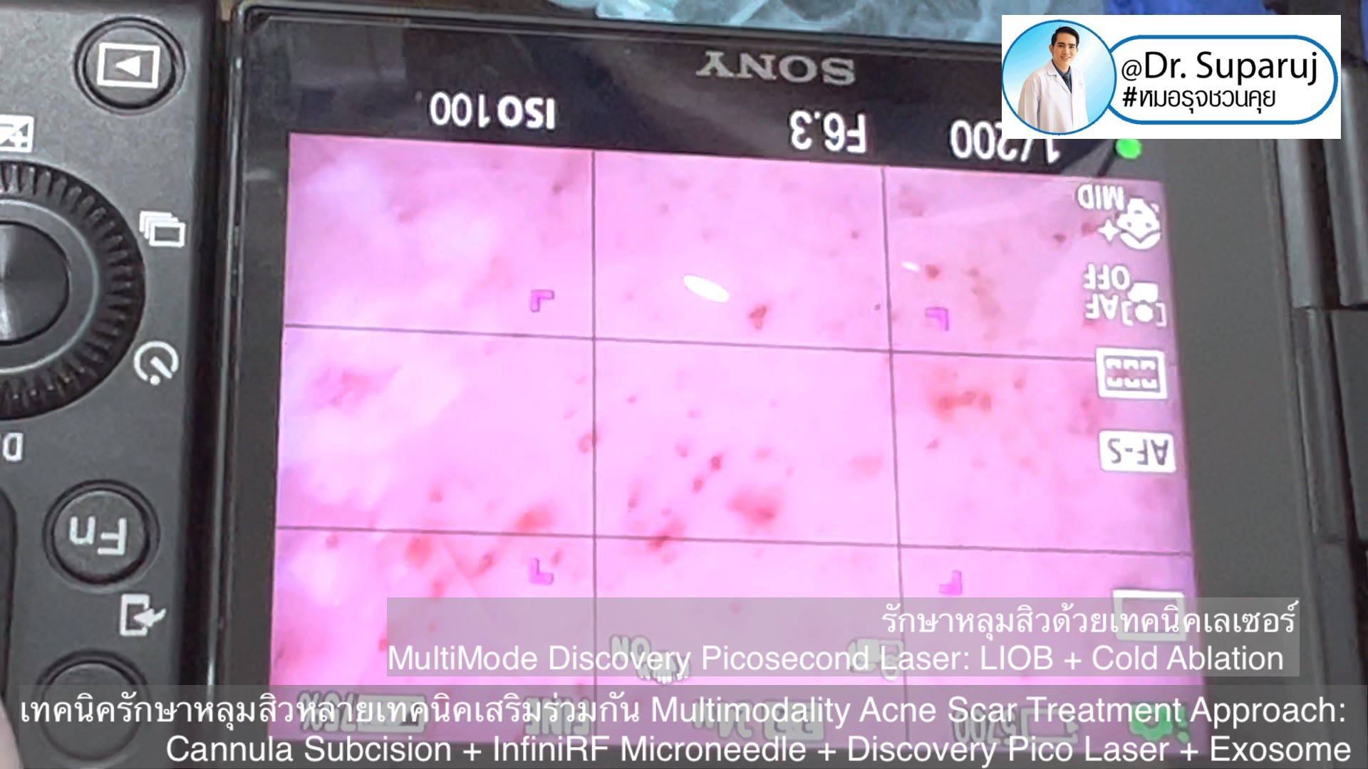 เทคนิครักษาหลุมสิวด้วยหลายเทคนิคเสริมร่วมกัน Multimodality Acne Scar Treatment Approach: Cannula Subcision + InfiniRF Microneedle + Discovery Pico Laser + Exosome เทคนิครักษาหลุมสิวด้วยหลายเทคนิคเสริมร่วมกัน Multimodality Acne Scar Treatment Approach: Cannula Subcision + InfiniRF Microneedle + Discovery Pico Laser + Exosome