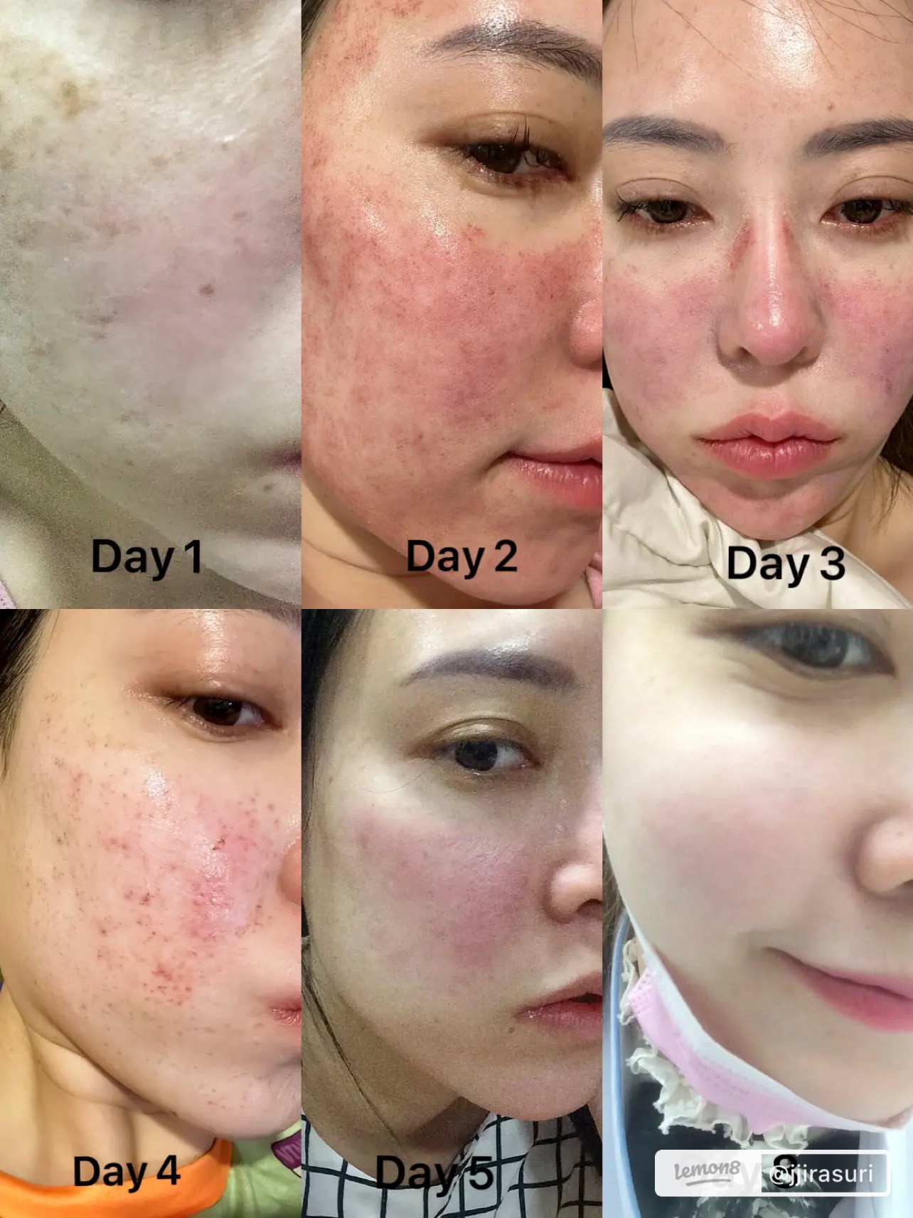 แนะนำเทคนิคดูแลรูขุมขนกว้าง: เทคนิคดูแลรูขุมขนกว้างด้วย Deep Carbon Peel Picosecond Laser (เทคนิคการใช้ Picosecond Laser พิโค่เลเซอร์ ร่วมกับผง carbon กระตุ้นการสร้างคอลลาเจนดูแลรูขุมขนกว้าง ) แนะนำเทคนิคดูแลรูขุมขนกว้าง: เทคนิคดูแลรูขุมขนกว้างด้วย Deep Carbon Peel Picosecond Laser (เทคนิคการใช้ Picosecond Laser พิโค่เลเซอร์ ร่วมกับผง carbon กระตุ้นการสร้างคอลลาเจนดูแลรูขุมขนกว้าง )