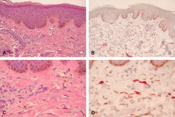 เทคนิครักษากระโฮริ กระลึก ปานโฮริ (Hori's nevus) ด้วยเลเซอร์ Discovery Picosecond Laser