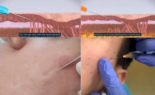 Update เทคนิค Subcision ตัดพังผืดรักษาหลุมสิว Acne Scar Subcision Techniques Update เทคนิค Subcision ตัดพังผืดรักษาหลุมสิว Acne Scar Subcision Techniques