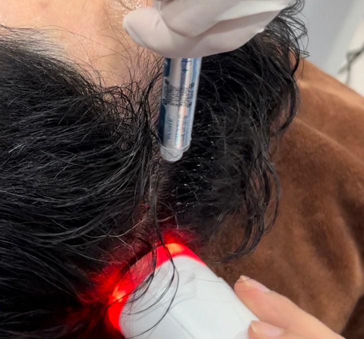 Update เทคนิค (เสริม)ดูแลผมร่วงผมบางจากพันธุกรรม AGA Update เทคนิค (เสริม)ดูแลผมร่วงผมบางจากพันธุกรรม AGA