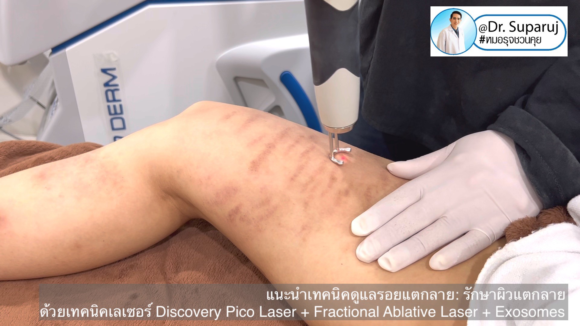 แนะนำเทคนิคดูแลรอยแตกลาย: รักษาผิวแตกลายด้วยเทคนิคเลเซอร์ Discovery Pico Laser + Fractional Ablative Laser + Exosomes แนะนำเทคนิคดูแลรอยแตกลาย: รักษาผิวแตกลายด้วยเทคนิคเลเซอร์ Discovery Pico Laser + Fractional Ablative Laser + Exosomes