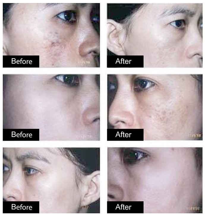 เทคนิครักษากระโฮริ กระลึก ปานโฮริ (Hori's nevus) ด้วยเลเซอร์ Discovery Picosecond Laser