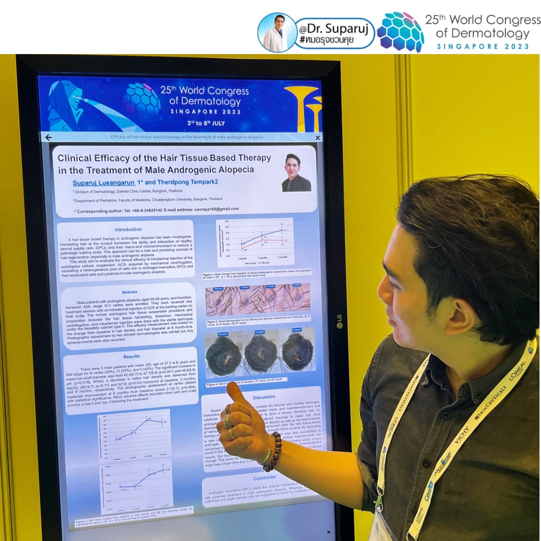 หมอรุจได้เข้าร่วมประชุม และนำเสนอผลงานวิจัยด้านการรักษาหลุมสิวแผลเป็นผมร่วงผมบาง ในงานประชุมแพทย์ผิวหนังระดับโลก World Congress of Dermatology WCD2023 ที่ประเทศสิงคโปร์ครับ หมอรุจได้เข้าร่วมประชุม และนำเสนอผลงานวิจัยด้านการรักษาหลุมสิวแผลเป็นผมร่วงผมบาง ในงานประชุมแพทย์ผิวหนังระดับโลก World Congress of Dermatology WCD2023 ที่ประเทศสิงคโปร์ครับ