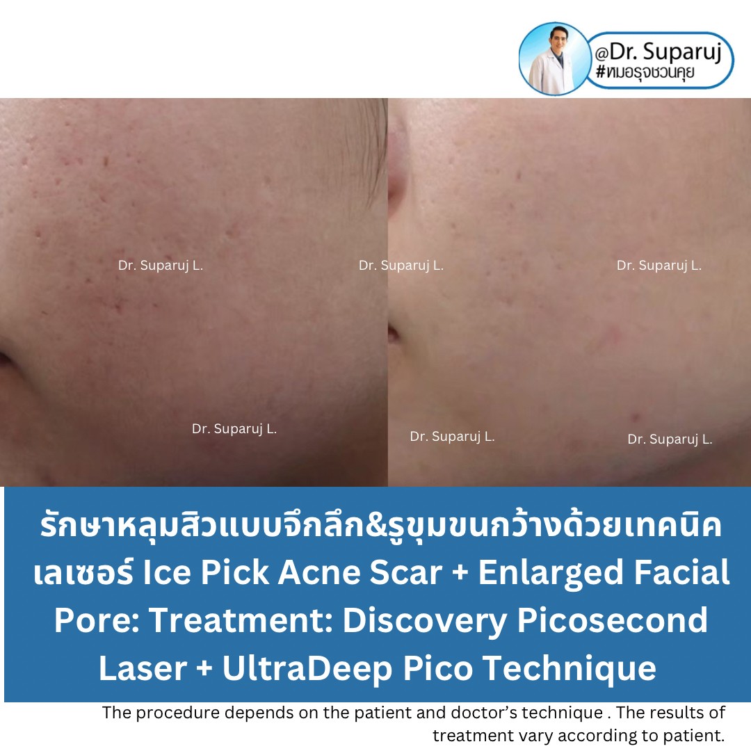 แนะนำเทคนิคดูแลรักษาหลุมสิว: เทคนิครักษาหลุมสิวด้วย 2 เทคนิคเสริมประสิทธิภาพ SYLFIRM X Plus + Discovery Pico Laser Combination Treatment แนะนำเทคนิคดูแลรักษาหลุมสิว: เทคนิครักษาหลุมสิวด้วย 2 เทคนิคเสริมประสิทธิภาพ SYLFIRM X Plus + Discovery Pico Laser Combination Treatment