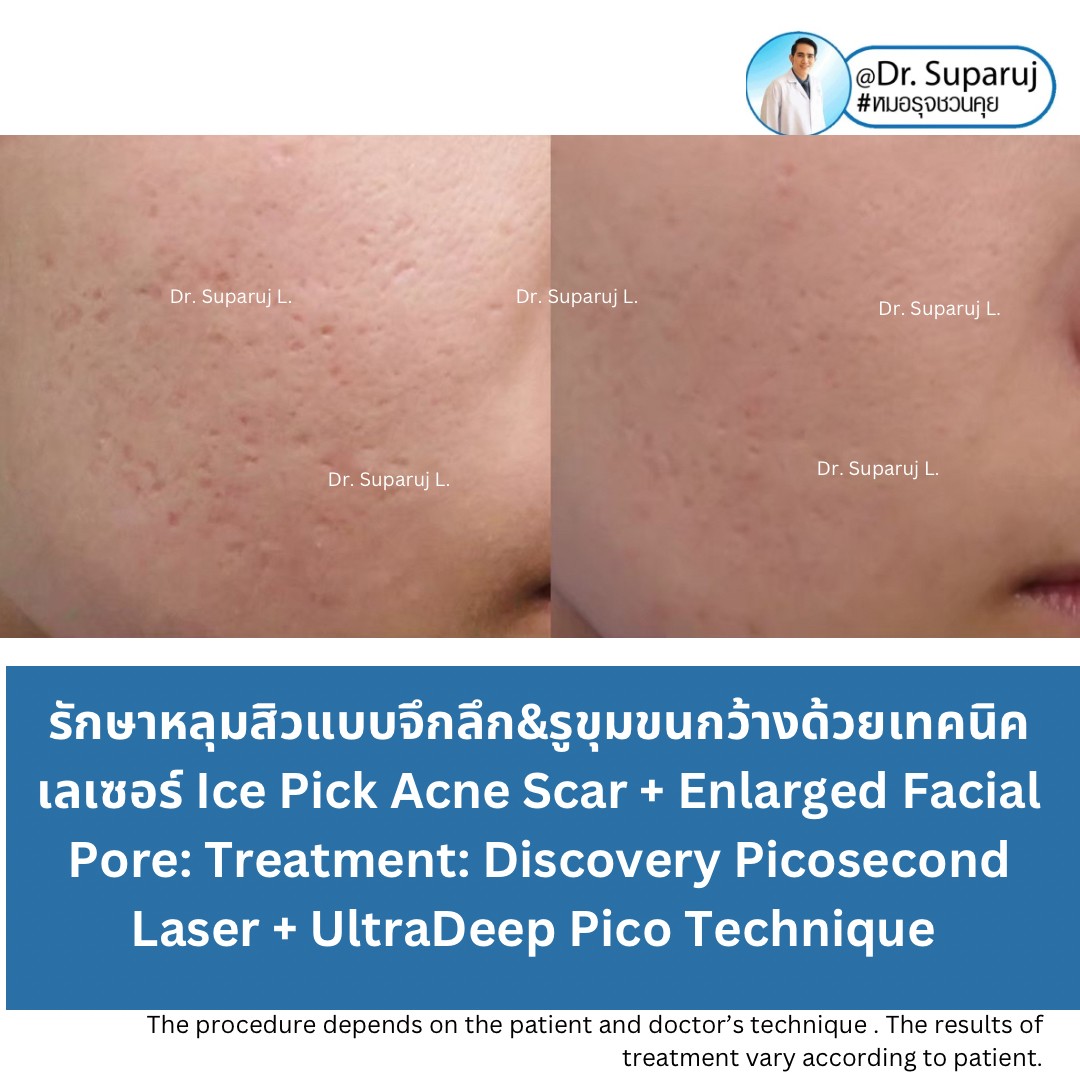 แนะนำเทคนิคดูแลรักษาหลุมสิว: เทคนิครักษาหลุมสิวด้วย 2 เทคนิคเสริมประสิทธิภาพ SYLFIRM X Plus + Discovery Pico Laser Combination Treatment แนะนำเทคนิคดูแลรักษาหลุมสิว: เทคนิครักษาหลุมสิวด้วย 2 เทคนิคเสริมประสิทธิภาพ SYLFIRM X Plus + Discovery Pico Laser Combination Treatment