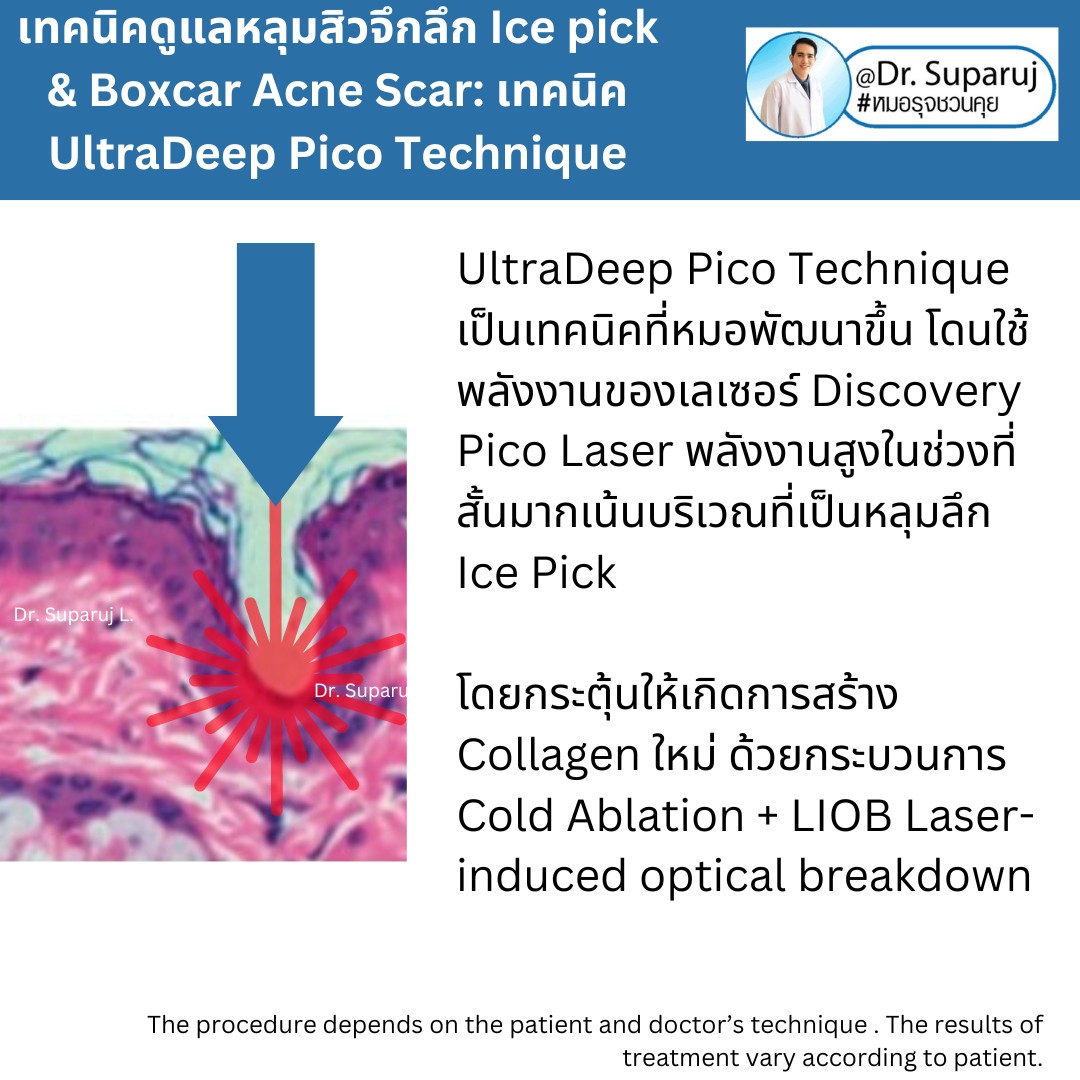 แนะนำเทคนิครักษาหลุมสิวจิกลึก Ice Pick Acne Scar ด้วยเทคนิคเลเซอร์ UltraDeep Pico Technique (Ice Pick Acne Scar Treatment with Discovery Pico Laser + UltraDeep Pico Technique) แนะนำเทคนิครักษาหลุมสิวจิกลึก Ice Pick Acne Scar ด้วยเทคนิคเลเซอร์ UltraDeep Pico Technique (Ice Pick Acne Scar Treatment with Discovery Pico Laser + UltraDeep Pico Technique)