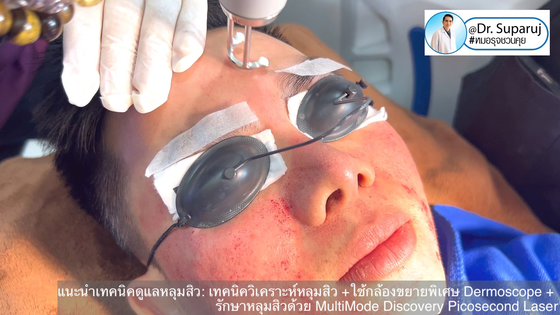 แนะนำเทคนิคดูแลหลุมสิว: เทคนิควิเคราะห์หลุมสิว +ใช้กล้องขยายพิเศษ Dermoscope + รักษาหลุมสิวด้วย MultiMode Discovery Picosecond Laser + Exosome Therapy