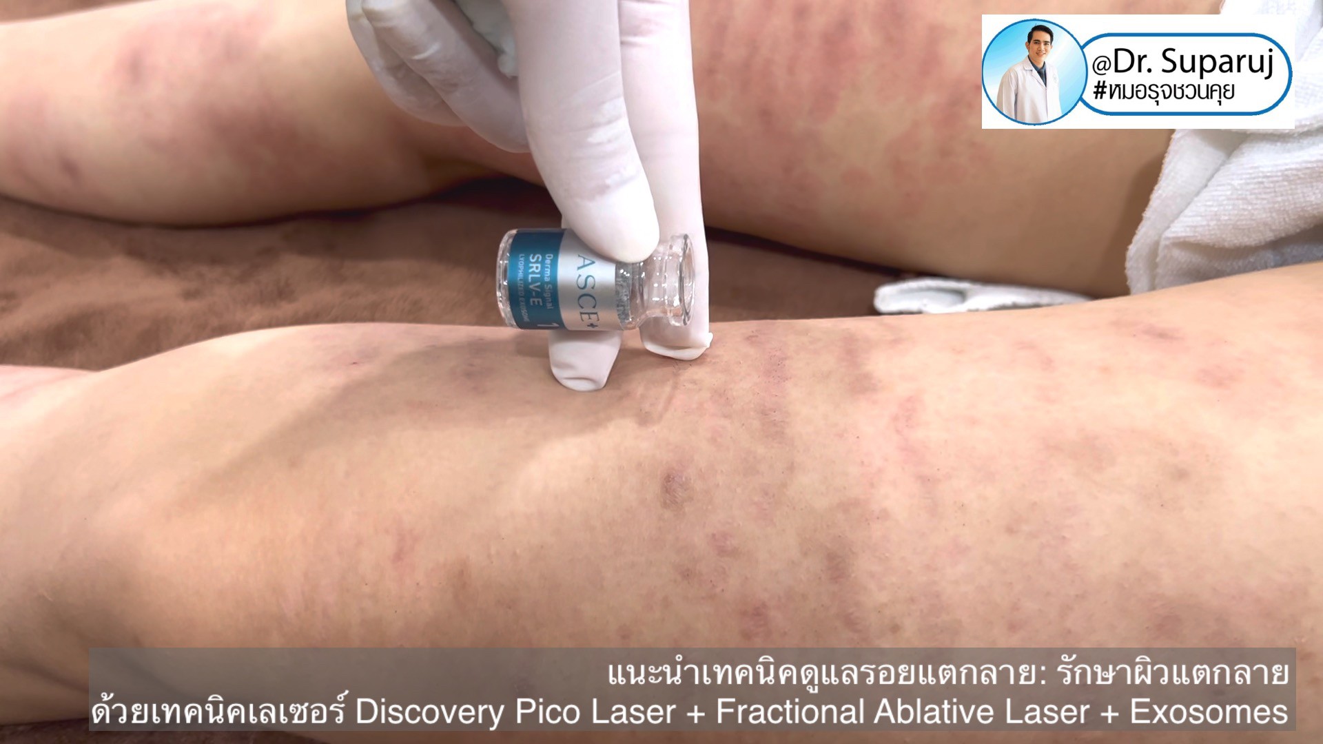 แนะนำเทคนิคดูแลรอยแตกลาย: รักษาผิวแตกลายด้วยเทคนิคเลเซอร์ Discovery Pico Laser + Fractional Ablative Laser + Exosomes แนะนำเทคนิคดูแลรอยแตกลาย: รักษาผิวแตกลายด้วยเทคนิคเลเซอร์ Discovery Pico Laser + Fractional Ablative Laser + Exosomes