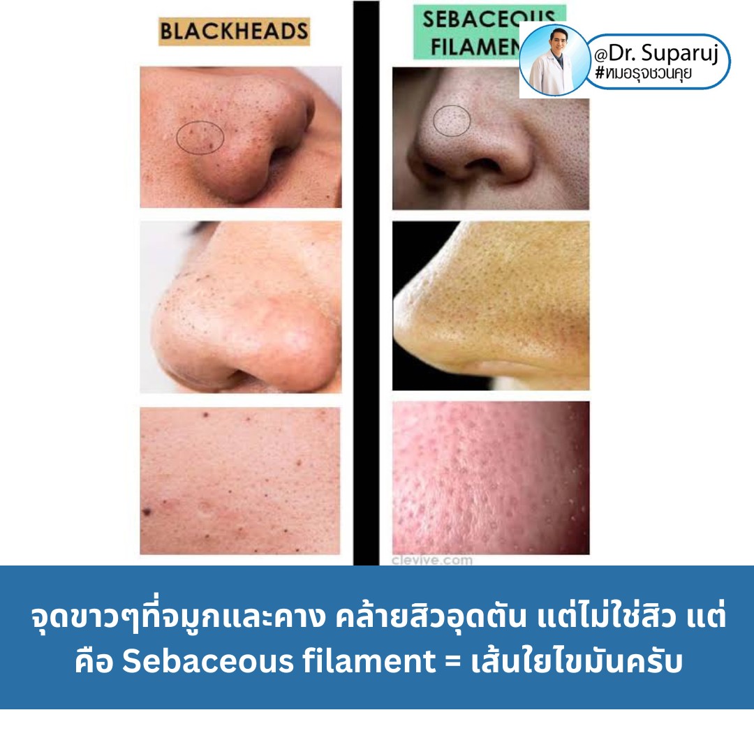 Sebaceous filament = เส้นใยไขมัน คืออะไรมี ?ลักษณะอย่างไร ? ดูแลได้อย่างไร? (คลิปเต็ม Full Clip YouTube Facebook: Dr. Suparuj ครับ