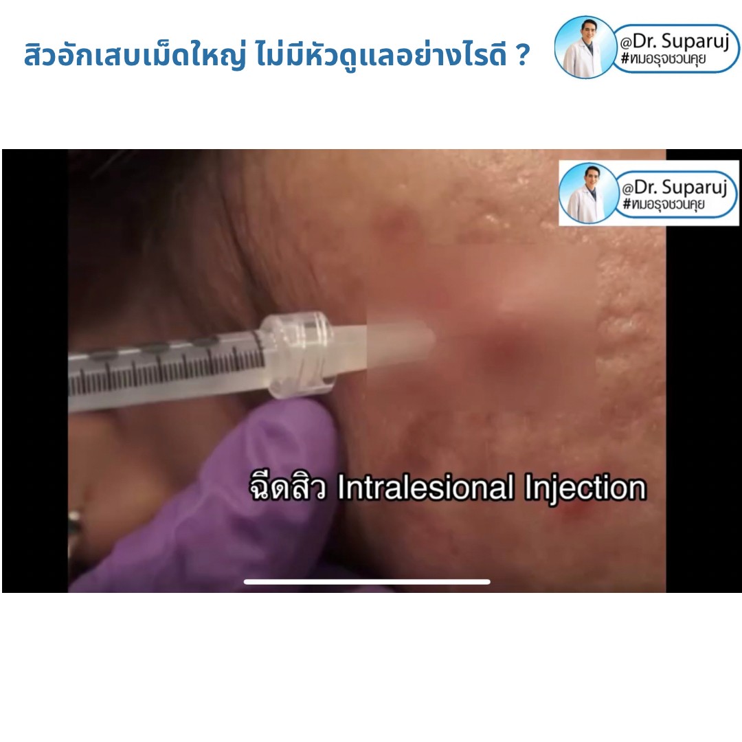 มีสิวอักเสบเม็ดใหญ่ ไม่มีหัว ขึ้น ดูแลอย่างไรดี ? มีสิวอักเสบเม็ดใหญ่ ไม่มีหัว ขึ้น ดูแลอย่างไรดี ?