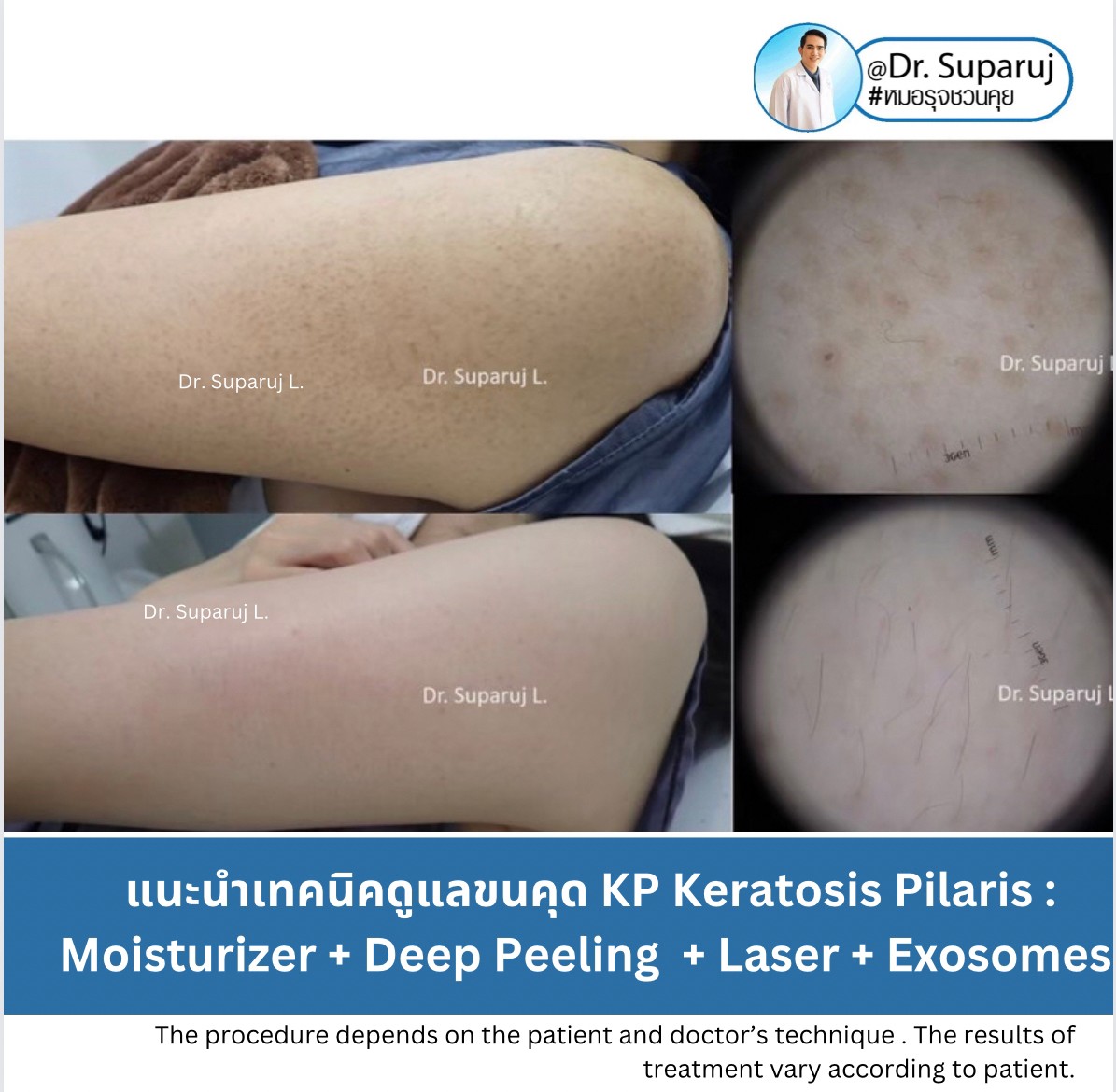 Update ขนคุด Keartosis Pilaris KP เกิดจากอะไร + มีลักษณะอย่างไร + ดูแลได้อย่างไร? Update ขนคุด Keartosis Pilaris KP เกิดจากอะไร + มีลักษณะอย่างไร + ดูแลได้อย่างไร?