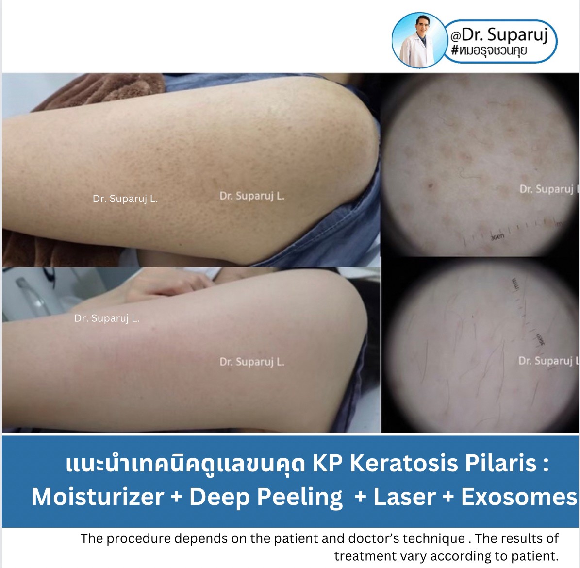 Update ขนคุด Keartosis Pilaris KP เกิดจากอะไร + มีลักษณะอย่างไร + ดูแลได้อย่างไร?