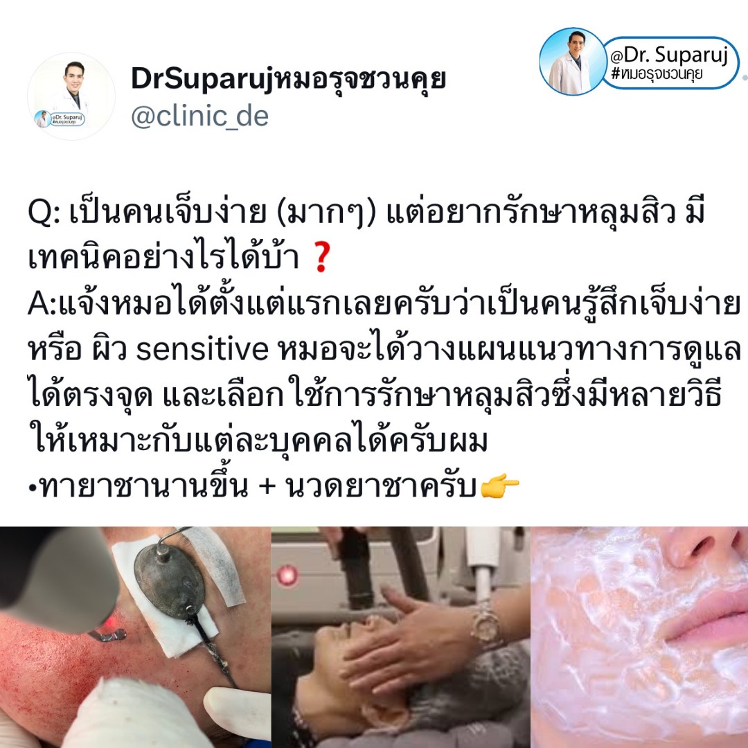 เป็นคนเจ็บง่าย (มากๆ) แต่อยากรักษาหลุมสิว มีเทคนิคอย่างไร? : เทคนิคลดอาการเจ็บจากการรักษาหลุมสิว เป็นคนเจ็บง่าย (มากๆ) แต่อยากรักษาหลุมสิว มีเทคนิคอย่างไร? : เทคนิคลดอาการเจ็บจากการรักษาหลุมสิว