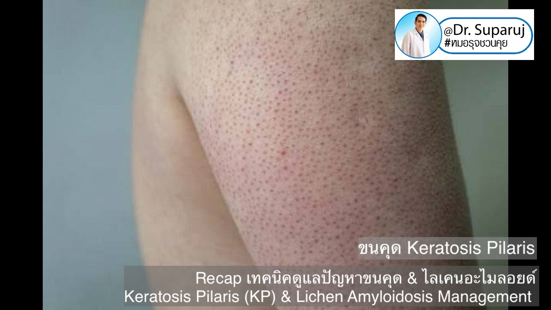 Recap เทคนิคดูแลปัญหาขนคุด & ไลเคนอะไมลอยด์ Keratosis Pilaris (KP) & Lichen Amyloidosis Management