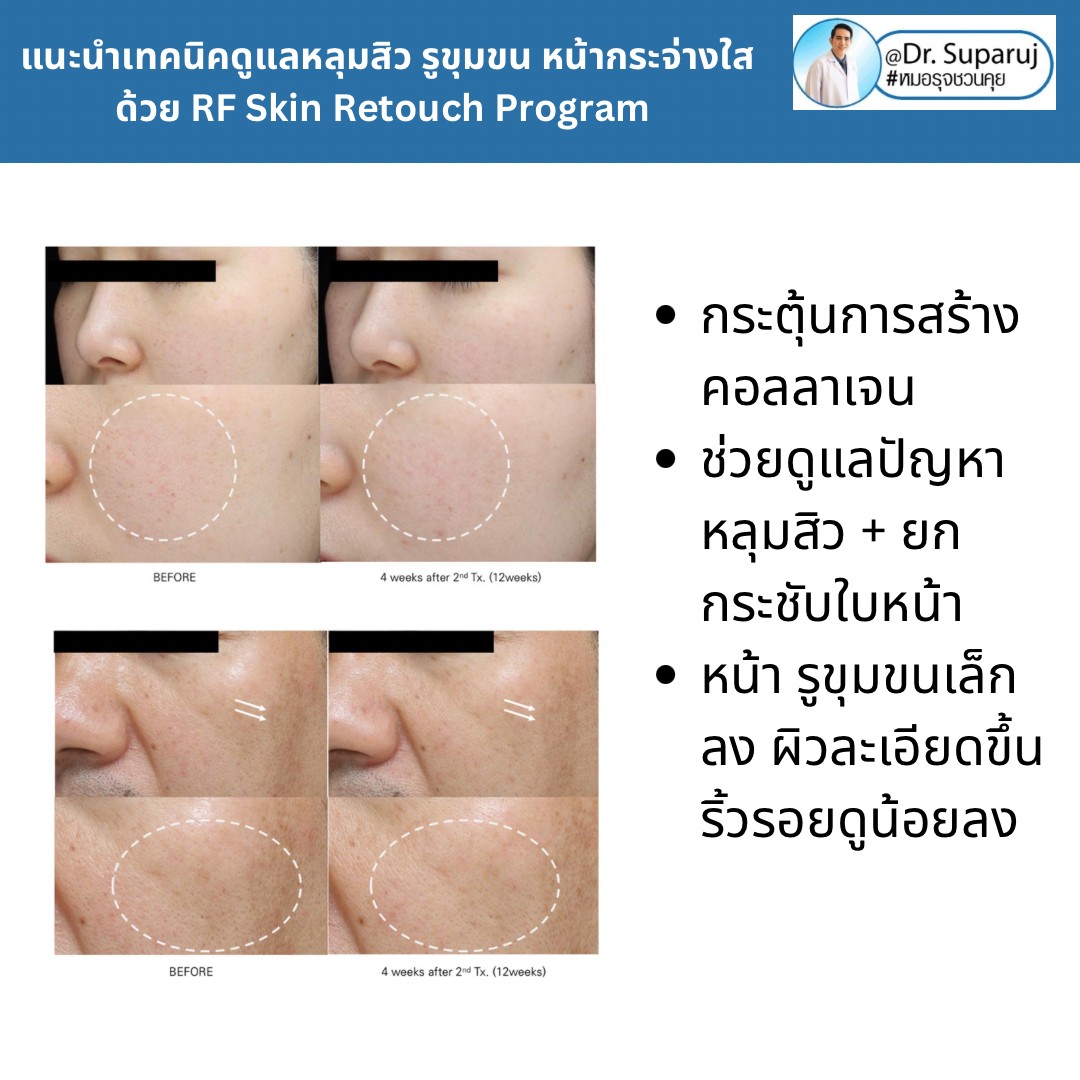 แนะนำเทคนิคดูแลหลุมสิว รูขุมขน หน้ากระจ่างใสด้วย RF Skin Retouch Program แนะนำเทคนิคดูแลหลุมสิว รูขุมขน หน้ากระจ่างใสด้วย RF Skin Retouch Program