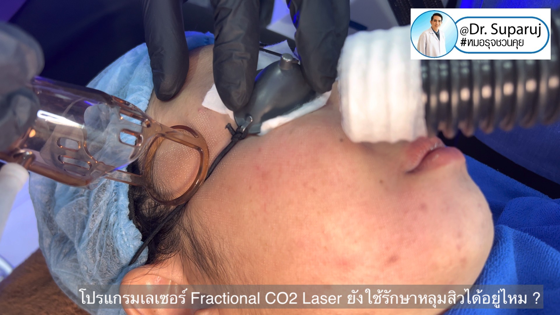 โปรแกรมเลเซอร์ Fractional CO2 Laser ยังใช้รักษาหลุมสิวได้อยู่ไหม ? โปรแกรมเลเซอร์ Fractional CO2 Laser ยังใช้รักษาหลุมสิวได้อยู่ไหม ?