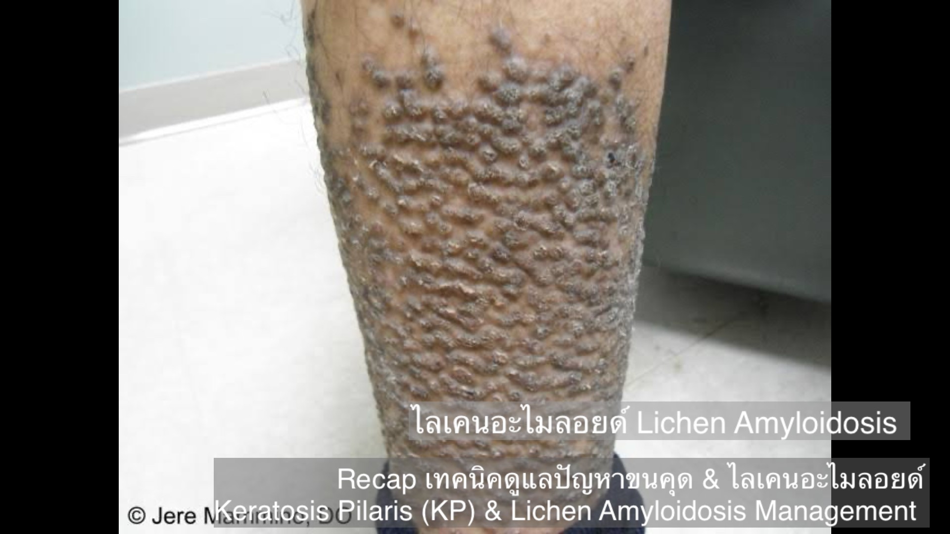 Recap เทคนิคดูแลปัญหาขนคุด & ไลเคนอะไมลอยด์ Keratosis Pilaris (KP) & Lichen Amyloidosis Management