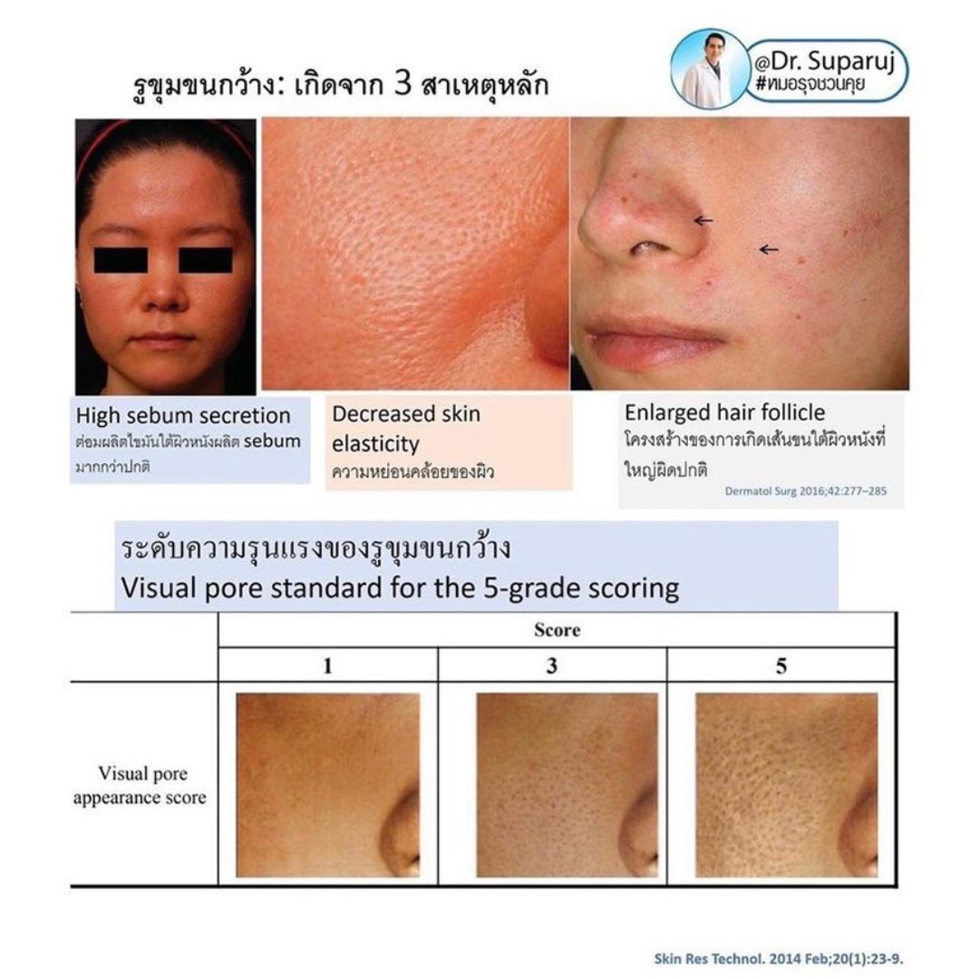 รูขุมขนกว้าง Enlarged Facial Pore เกิดจากอะไร ? + เทคนิคดูแลด้วยโปรแกรม Discovery Pico Laser หลายความยาวคลื่น +หลายพลังงานร่วมกัน รูขุมขนกว้าง Enlarged Facial Pore เกิดจากอะไร ? + เทคนิคดูแลด้วยโปรแกรม Discovery Pico Laser หลายความยาวคลื่น +หลายพลังงานร่วมกัน