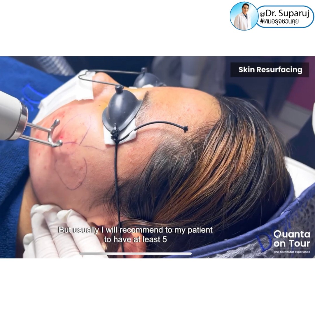 Quanta On Tour - Thailand - Dr. Suparuj DEMED CLINIC about Discovery Pico Laser & Acne Scar Treatment August 2023 - Quanta goes to Thailand to support and highlight the experience of its exclusive distributor for aesthetic lasers Lasermed, by visiting Quanta On Tour - Thailand - Dr. Suparuj DEMED CLINIC about Discovery Pico Laser & Acne Scar Treatment August 2023 - Quanta goes to Thailand to support and highlight the experience of its exclusive distributor for aesthetic lasers Lasermed, by visiting