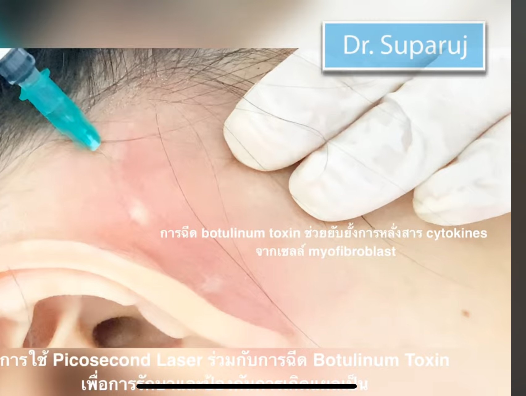 Update เทคนิครักษาแผลเป็นนูนคีลอยด์แผลผ่าตัดด้วยการใช้หลายเลเซอร์ร่วมกัน + เทคนิคการใช้การฉีดโบทูลินัมท็อกซิน (Botox) รักษาแผลเป็นนูนคีลอยด์ Update เทคนิครักษาแผลเป็นนูนคีลอยด์แผลผ่าตัดด้วยการใช้หลายเลเซอร์ร่วมกัน + เทคนิคการใช้การฉีดโบทูลินัมท็อกซิน (Botox) รักษาแผลเป็นนูนคีลอยด์