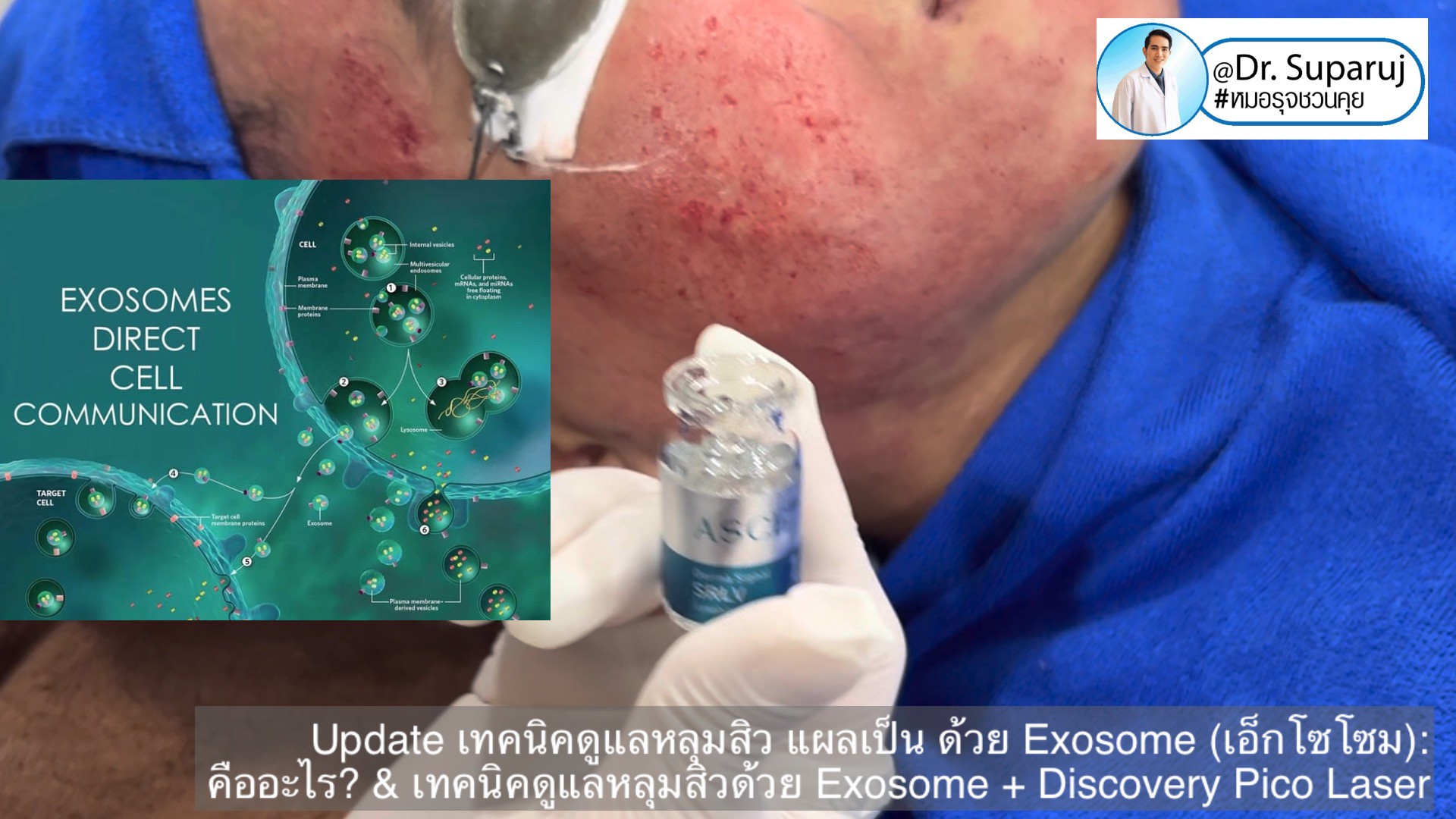 แนะนำเทคนิคในการดูแลหลุมสิว: Exosome ใน การรักษาหลุมสิว (Exosome & acne scar treatment) แนะนำเทคนิคในการดูแลหลุมสิว: Exosome ใน การรักษาหลุมสิว (Exosome & acne scar treatment)