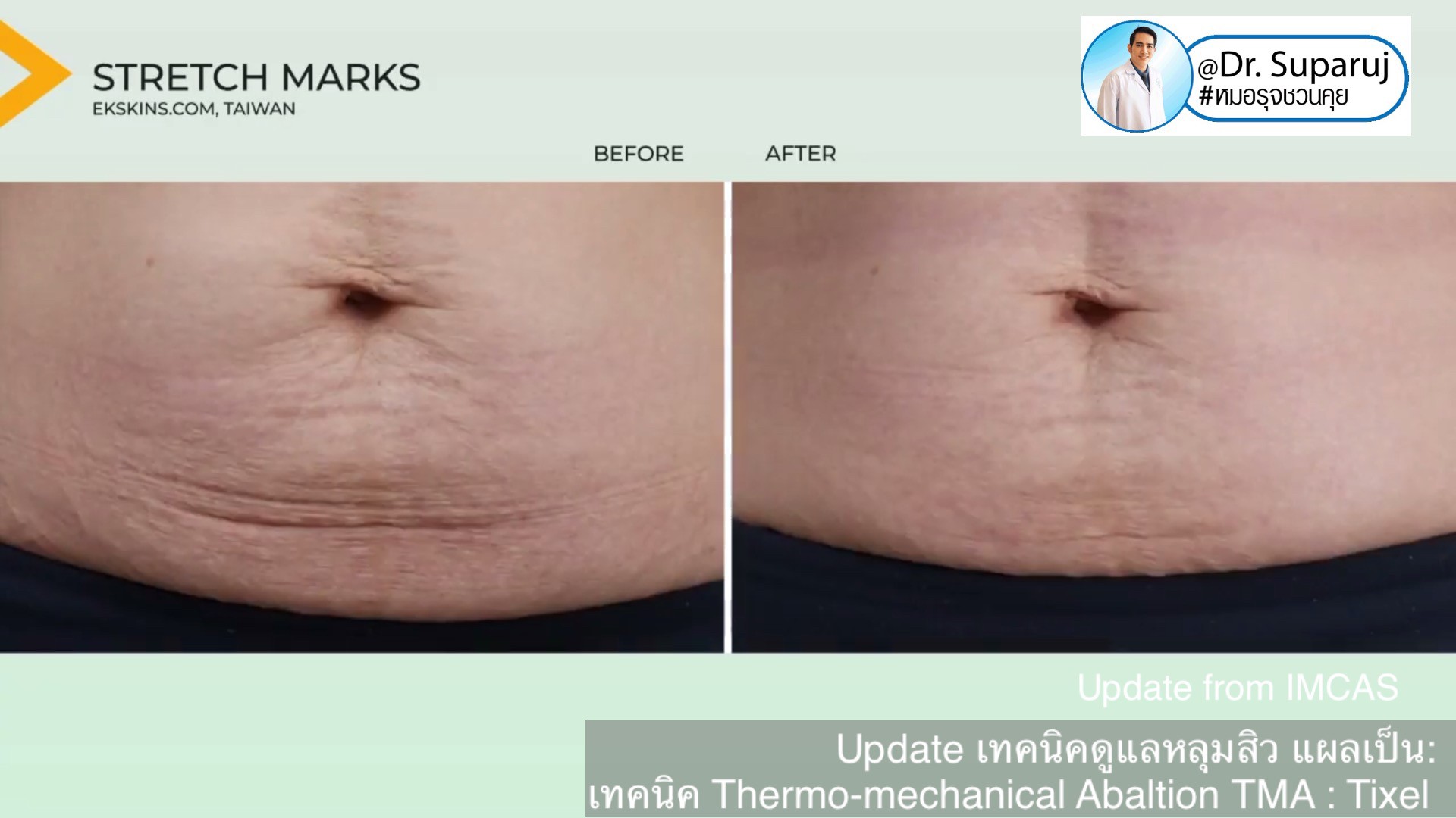 Update from IMCAS เทคนิครักษาหลุมสิว แผลเป็น ริ้วรอย: Tixel เทคนิค Thermo-mechanical Abaltion TMA Update from IMCAS เทคนิครักษาหลุมสิว แผลเป็น ริ้วรอย: Tixel เทคนิค Thermo-mechanical Abaltion TMA