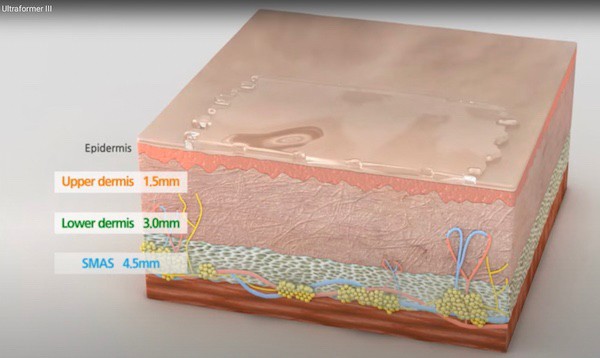 แนะนำเทคนิคยกกระชับใบหน้า: วิเคราะห์ผิว +ยกกระชับด้วย Ultraformer III ( Facial Analysis and Ultraformer III for Facial Tightening & Lifting) แนะนำเทคนิคยกกระชับใบหน้า: วิเคราะห์ผิว +ยกกระชับด้วย Ultraformer III ( Facial Analysis and Ultraformer III for Facial Tightening & Lifting)
