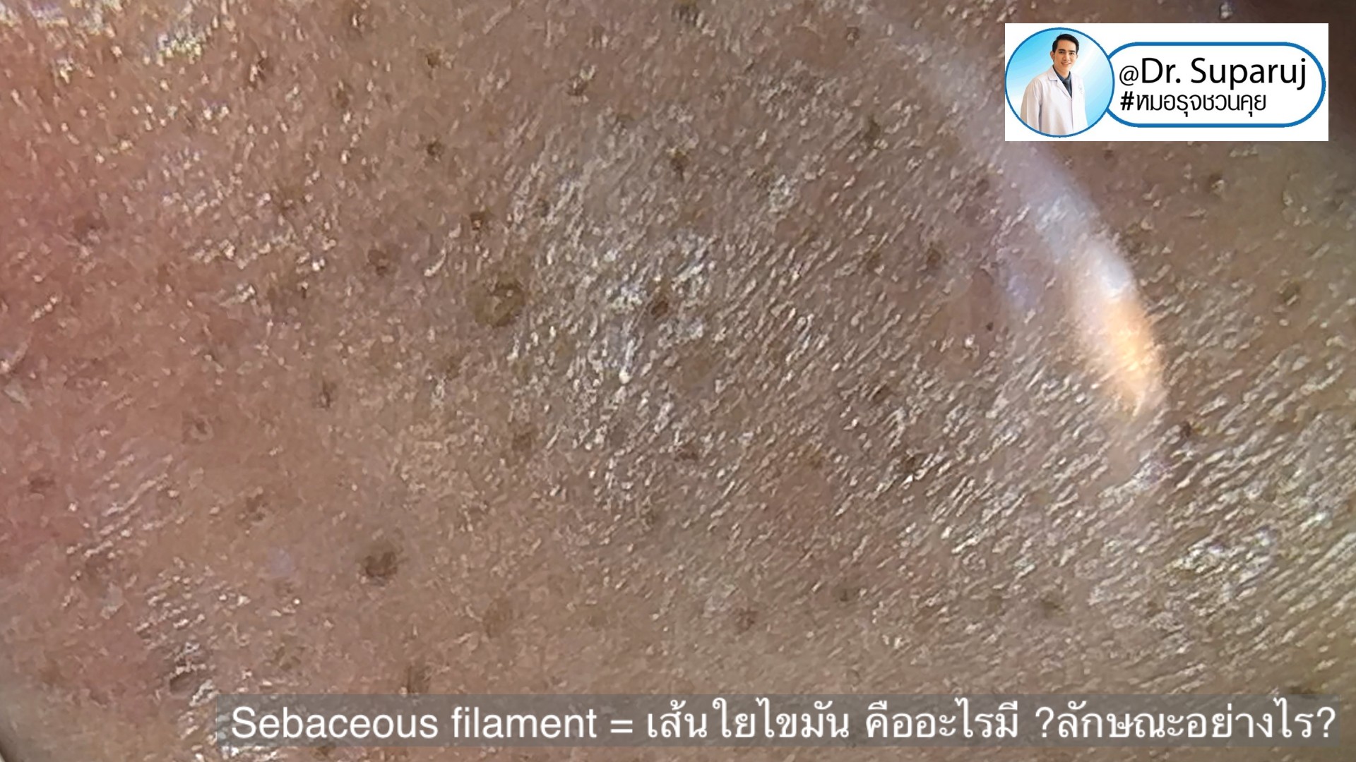 Sebaceous filament = เส้นใยไขมัน คืออะไรมี ?ลักษณะอย่างไร ? ดูแลได้อย่างไร? (คลิปเต็ม Full Clip YouTube Facebook: Dr. Suparuj ครับ