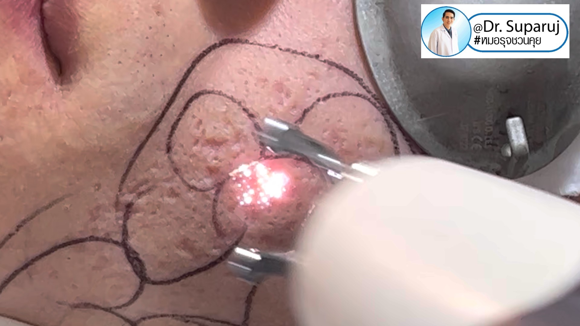 Back to the Basics: หลุมสิวมีกี่ชนิด & มีลักษณะอย่างไร ? Acne Scar Classification Full Clip คลิปเต็ม Facebook/ YouTube Dr. Suparuj หมอรุจชวนคุย ครับ Back to the Basics: หลุมสิวมีกี่ชนิด & มีลักษณะอย่างไร ? Acne Scar Classification Full Clip คลิปเต็ม Facebook/ YouTube Dr. Suparuj หมอรุจชวนคุย ครับ