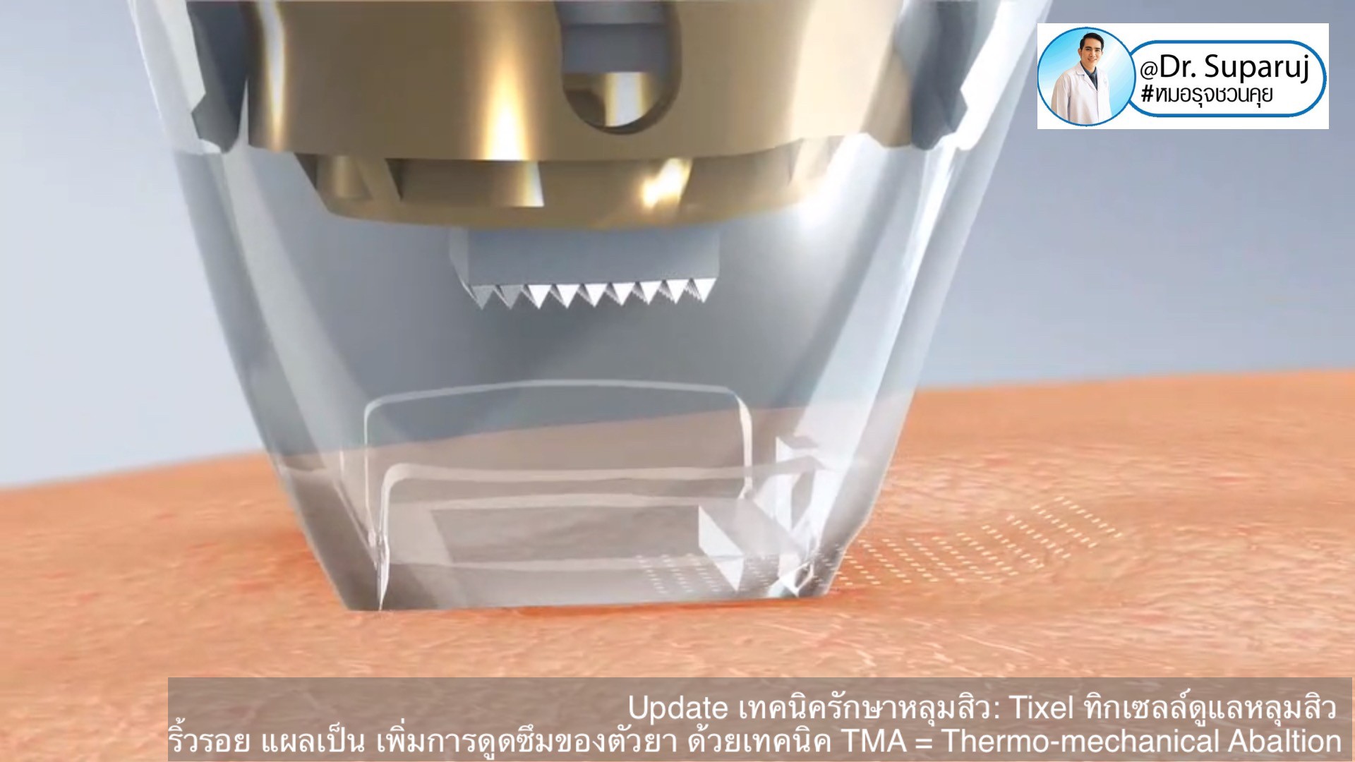 Update เทคนิครักษาหลุมสิว: Tixel ทิ๊กเซลล์ รักษาหลุมสิว ริ้วรอย แผลเป็น เพิ่มการดูดซึมยาด้วยเทคนิค TMA = Thermo-mechanical Abaltion Update เทคนิครักษาหลุมสิว: Tixel ทิ๊กเซลล์ รักษาหลุมสิว ริ้วรอย แผลเป็น เพิ่มการดูดซึมยาด้วยเทคนิค TMA = Thermo-mechanical Abaltion