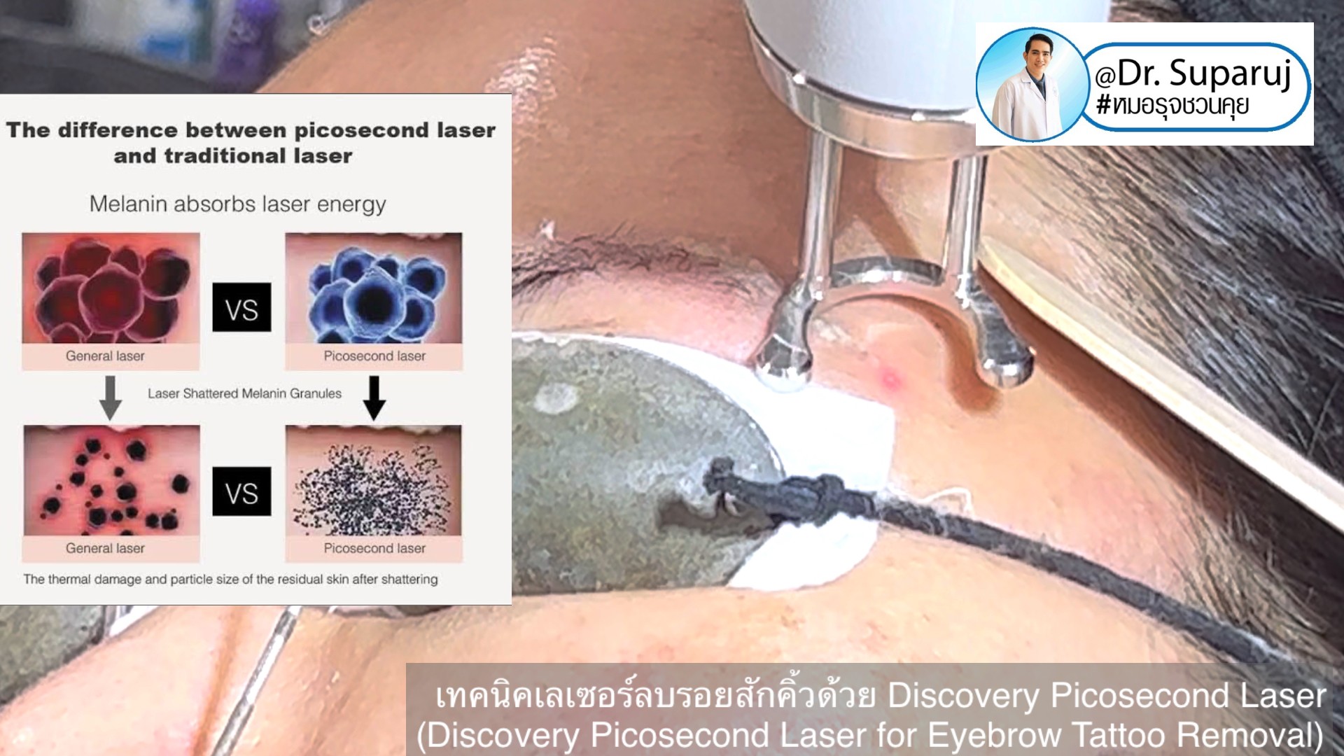 เทคนิคเลเซอร์ลบรอยสักคิ้วด้วย Discovery Picosecond Laser (Discovery Picosecond Laser for Eyebrow Tattoo Removal)