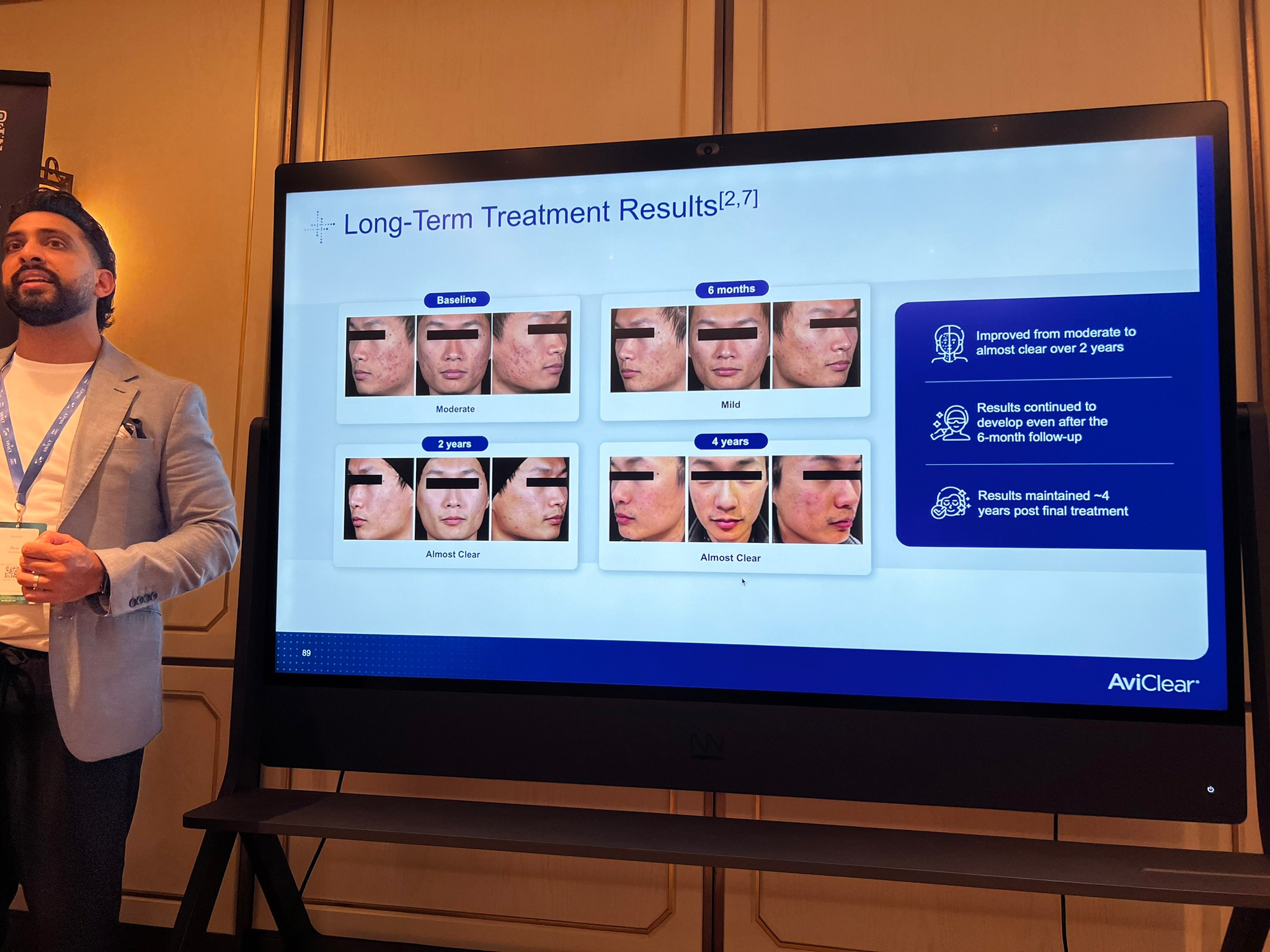 Update เครื่องเลเซอร์สำหรับรักษาสิวโดยเฉพาะ จับกับต่อมไขมันโดยตรง = AviClear 1726 nm Laser Update เครื่องเลเซอร์สำหรับรักษาสิวโดยเฉพาะ จับกับต่อมไขมันโดยตรง = AviClear 1726 nm Laser