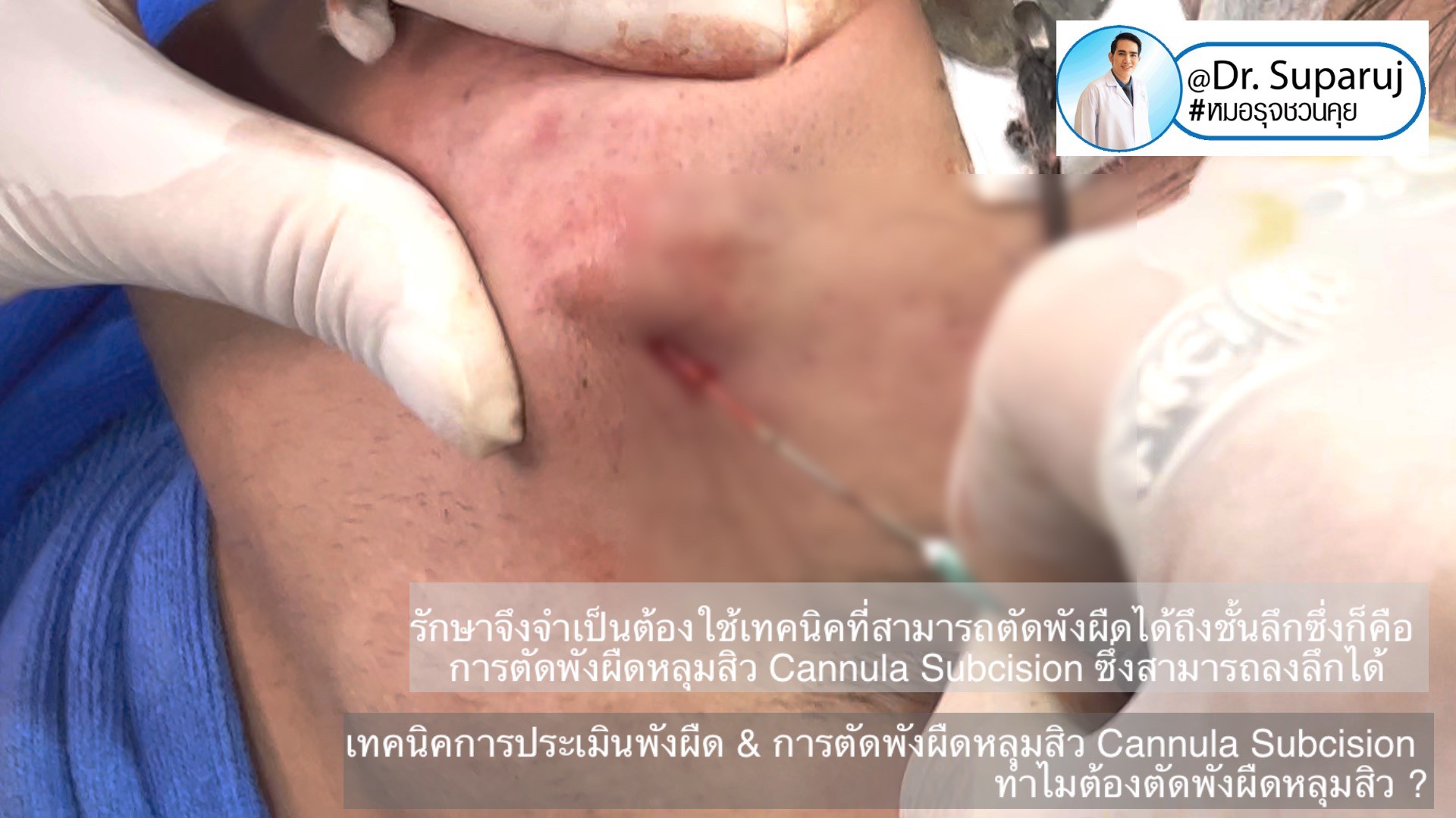 เทคนิคการประเมินพังผืด และการตัดพังผืดหลุมสิว Cannula Subcision ทำไมต้องตัดพังผืดรักษาหลุมสิว ? (Acne Scar Fibrosis Evaluation & Cannula Subcision Treatment) เทคนิคการประเมินพังผืด และการตัดพังผืดหลุมสิว Cannula Subcision ทำไมต้องตัดพังผืดรักษาหลุมสิว ? (Acne Scar Fibrosis Evaluation & Cannula Subcision Treatment)