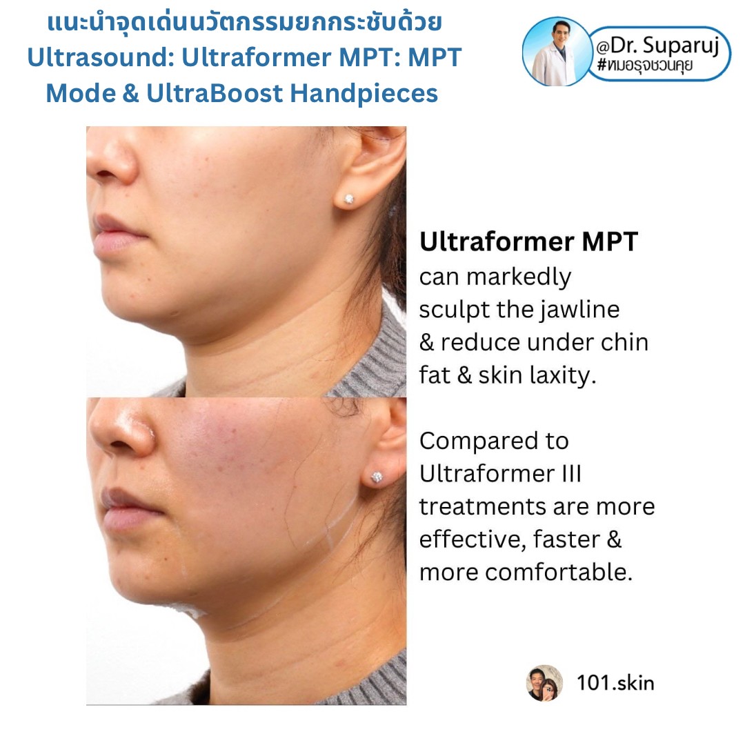 แนะนำนวัตกรรม พลังงานเครื่องเสียง Macro & Micro Focused Ultrasound ยกกระชับผิว Ultraformer MPT: จุดเด่น + ทดสอบลักษณะพลังงาน + การประเมินลักษณะผิว ให้เห็นกันชัดๆเลยครับ แนะนำนวัตกรรม พลังงานเครื่องเสียง Macro & Micro Focused Ultrasound ยกกระชับผิว Ultraformer MPT: จุดเด่น + ทดสอบลักษณะพลังงาน + การประเมินลักษณะผิว ให้เห็นกันชัดๆเลยครับ