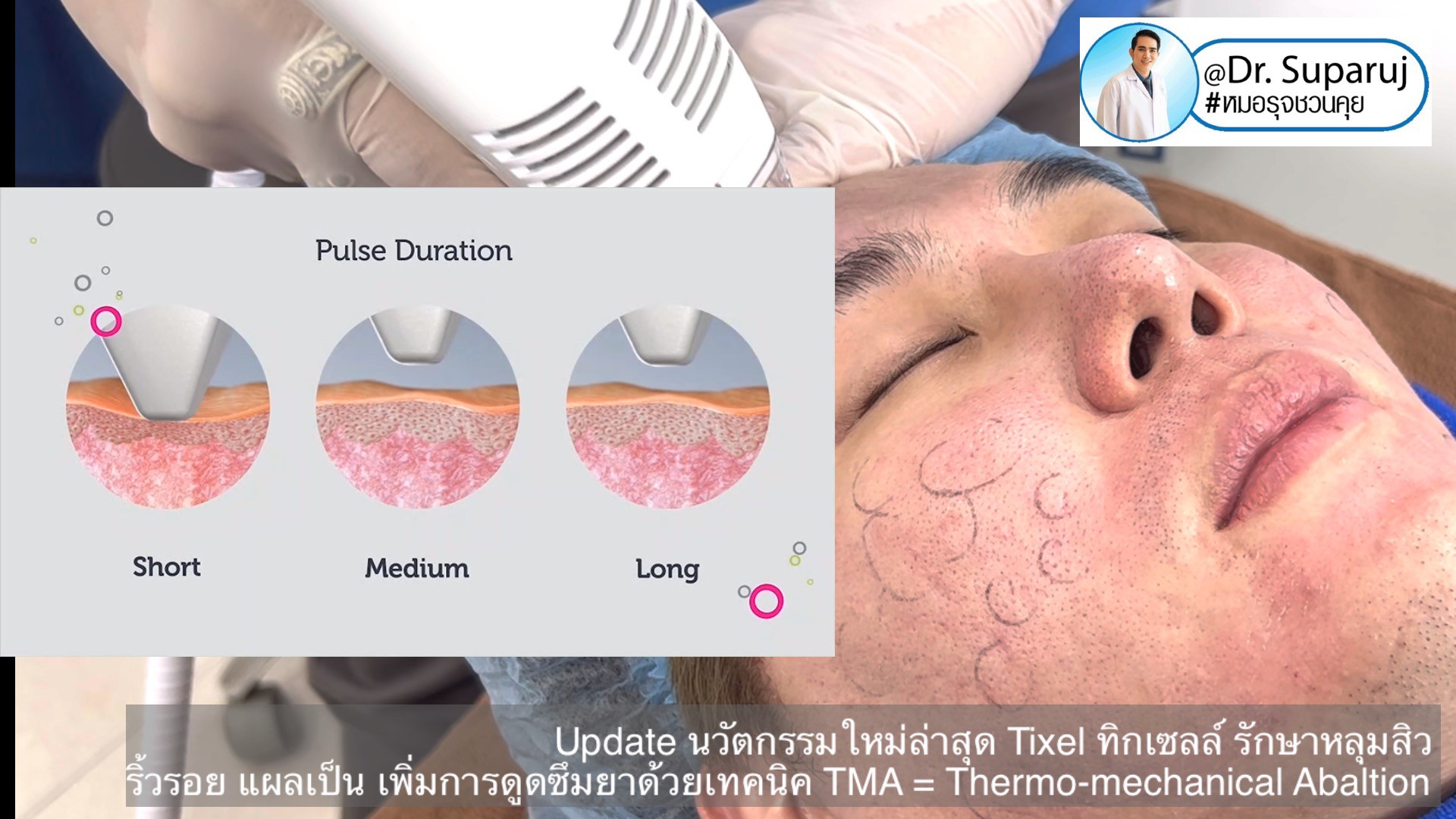 Update นวัตกรรมใหม่ล่าสุด Tixel ทิ๊กเซลล์ รักษาหลุมสิว ริ้วรอย แผลเป็น + Periorbital Tixel Treatment ดูแลริ้วรอยเปลือกตาและรอบดวงตาด้วยเทคนิค TMA = Thermo-mechanical Abaltion