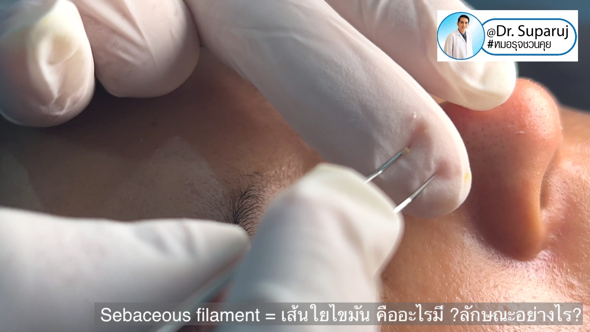 Sebaceous filament = เส้นใยไขมัน คืออะไรมี ?ลักษณะอย่างไร ? ดูแลได้อย่างไร? (คลิปเต็ม Full Clip YouTube Facebook: Dr. Suparuj ครับ Sebaceous filament = เส้นใยไขมัน คืออะไรมี ?ลักษณะอย่างไร ? ดูแลได้อย่างไร? (คลิปเต็ม Full Clip YouTube Facebook: Dr. Suparuj ครับ