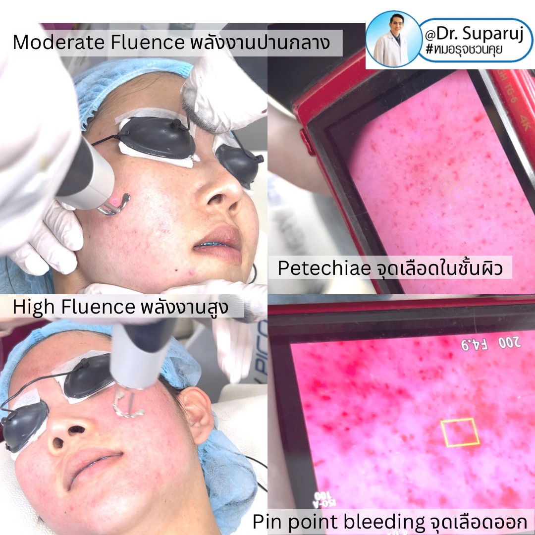 Q:Picosecond Laser หลุมสิวต้องยิงให้เลือดสาดไหม? Q:Picosecond Laser หลุมสิวต้องยิงให้เลือดสาดไหม?