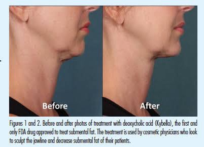 สาเหตุ & เทคนิคลดเหนียง ไขมันใต้คาง คาง 2 ชั้น Double Chin & Submental Fullness Treatment สาเหตุ & เทคนิคลดเหนียง ไขมันใต้คาง คาง 2 ชั้น Double Chin & Submental Fullness Treatment