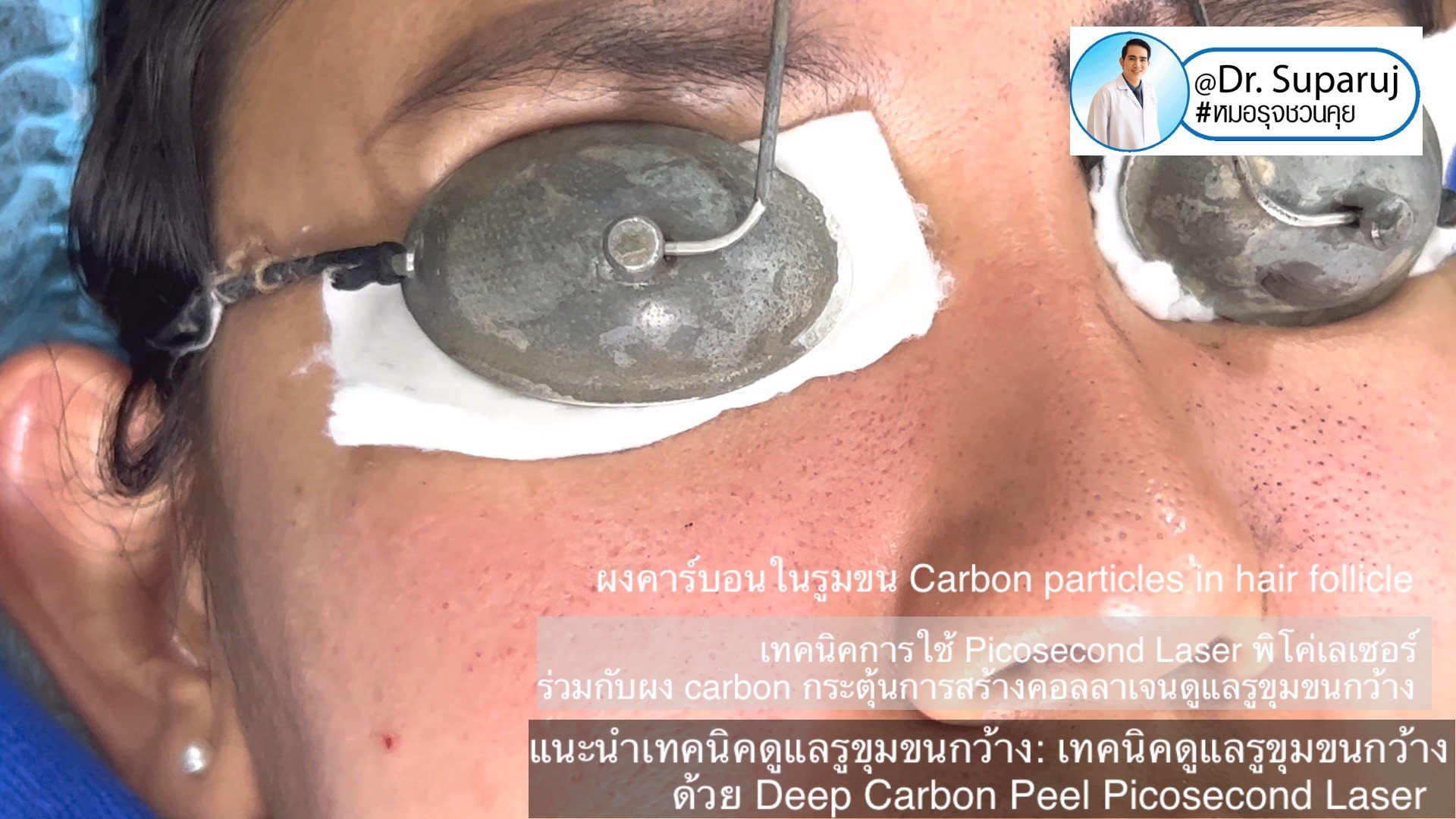 แนะนำเทคนิคดูแลรูขุมขนกว้าง: เทคนิคดูแลรูขุมขนกว้างด้วย Deep Carbon Peel Picosecond Laser (เทคนิคการใช้ Picosecond Laser พิโค่เลเซอร์ ร่วมกับผง carbon กระตุ้นการสร้างคอลลาเจนดูแลรูขุมขนกว้าง ) แนะนำเทคนิคดูแลรูขุมขนกว้าง: เทคนิคดูแลรูขุมขนกว้างด้วย Deep Carbon Peel Picosecond Laser (เทคนิคการใช้ Picosecond Laser พิโค่เลเซอร์ ร่วมกับผง carbon กระตุ้นการสร้างคอลลาเจนดูแลรูขุมขนกว้าง )