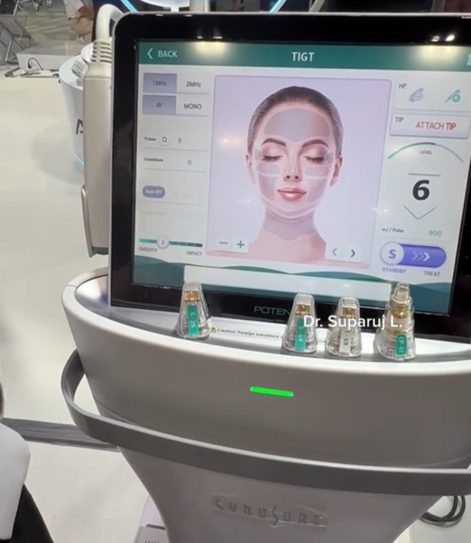 Update นวัตกรรมยกกระชับผิว ดูแลหลุมสิว ลดริ้วรอย: Potenza RF Microneedling โพเทนซ่า Update นวัตกรรมยกกระชับผิว ดูแลหลุมสิว ลดริ้วรอย: Potenza RF Microneedling โพเทนซ่า