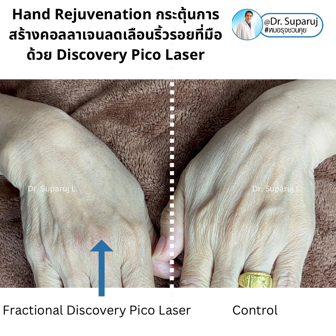 เทคนิคดูแลริ้วรอย เหี่ยวย่น กระตุ้นการสร้างคอลลาเจน ที่ส่วนลำคอหน้าอก แขน มือ หน้าอก ด้วย Discovery Pico Laser