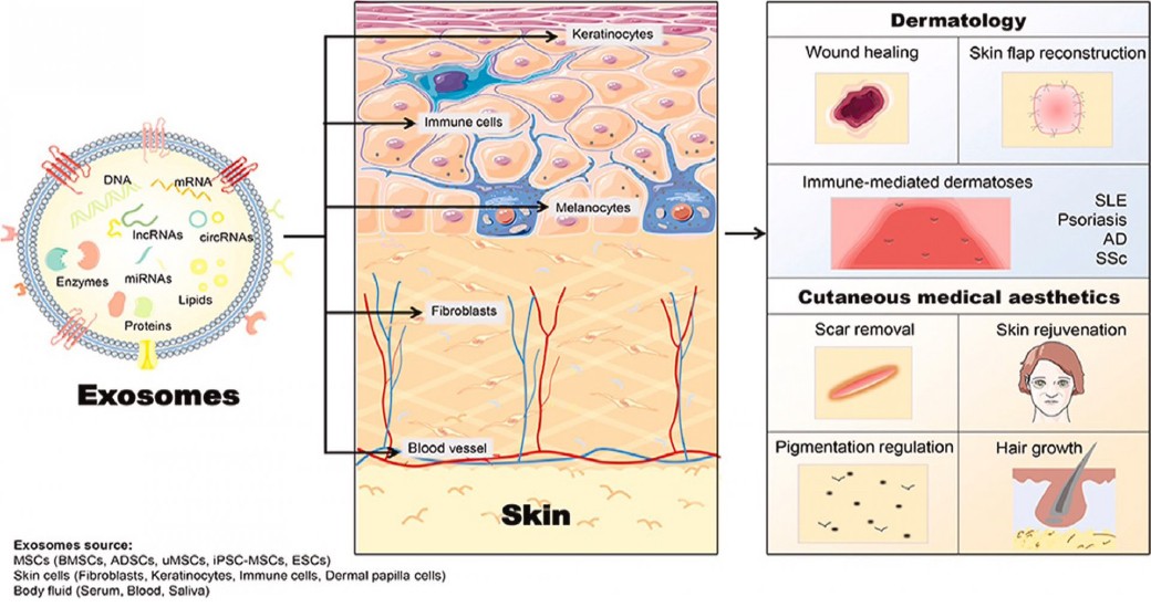 แนะนำเทคนิคดูแลปัญหาผมร่วงผมบาง: Exosome เอ็กโซโซม ช่วยดูแลผมร่วงผมบางได้อย่างไร Exosome Therapy for Hair Loss แนะนำเทคนิคดูแลปัญหาผมร่วงผมบาง: Exosome เอ็กโซโซม ช่วยดูแลผมร่วงผมบางได้อย่างไร Exosome Therapy for Hair Loss