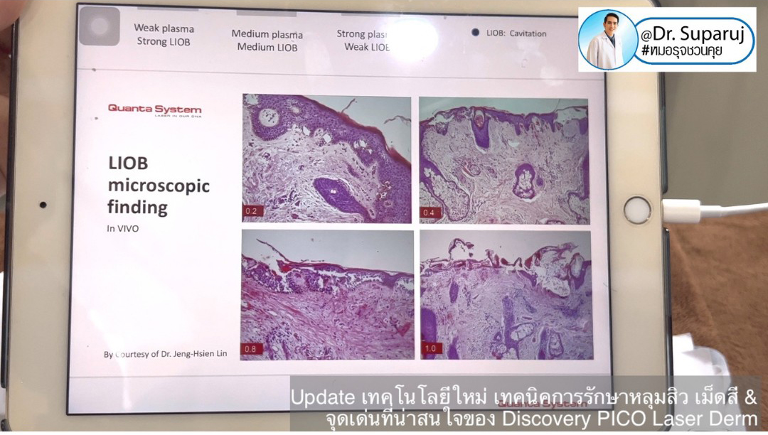 Update Discovery Picosecond Laser จุดเด่น & หลักการทำงาน ใช้ดูแลหลุมสิว แผลเป็น รอยแตกลาย ฝ้า กระจุดด่างดำ ได้อย่างไร ? Update Discovery Picosecond Laser จุดเด่น & หลักการทำงาน ใช้ดูแลหลุมสิว แผลเป็น รอยแตกลาย ฝ้า กระจุดด่างดำ ได้อย่างไร ?
