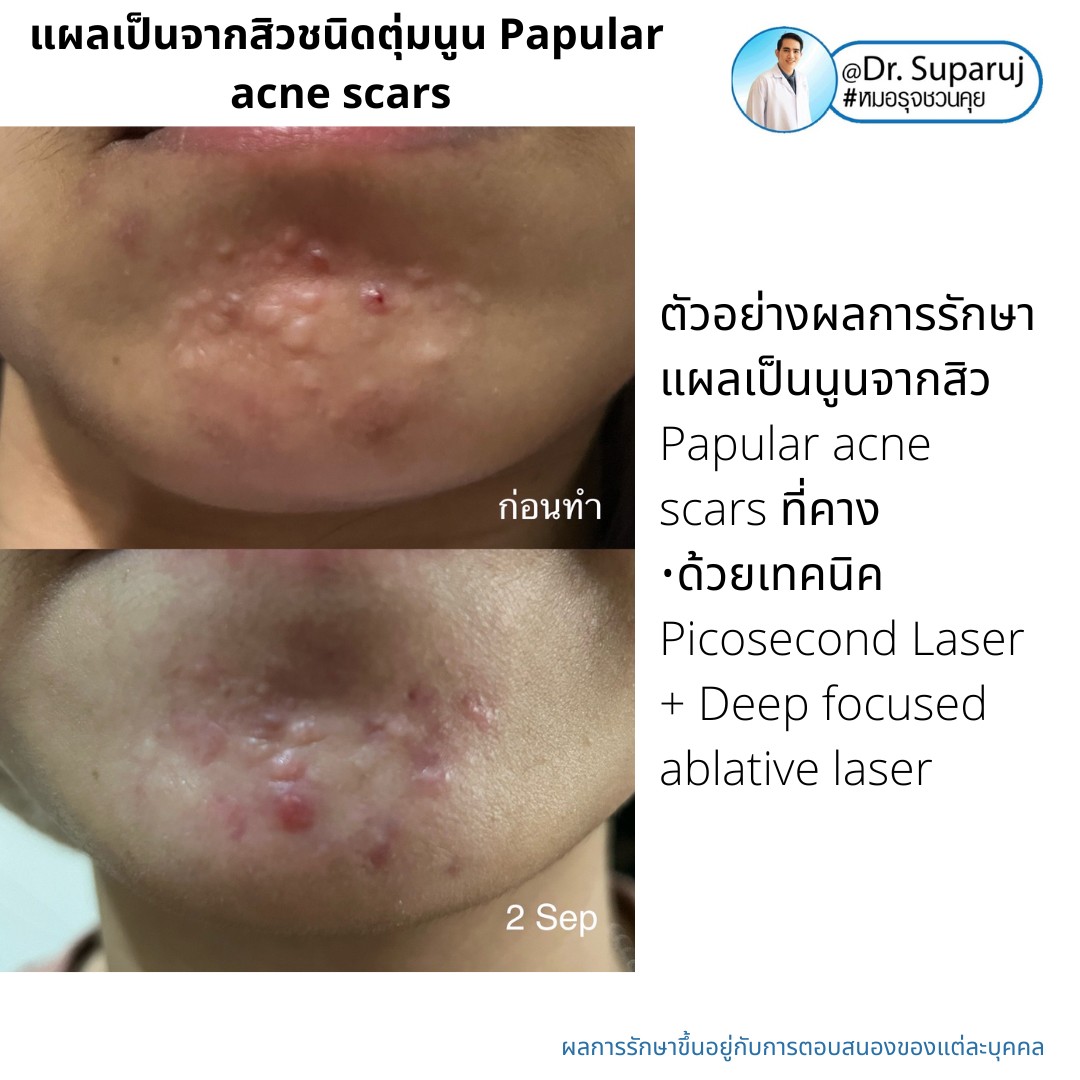 เทคนิคดูแลแผลเป็นตุ่มนูนจากสิว Papular acne scar ที่จมูก + คาง ด้วย Fractional Discovery Picosecond Laser + Deep Focused Ablative Laser